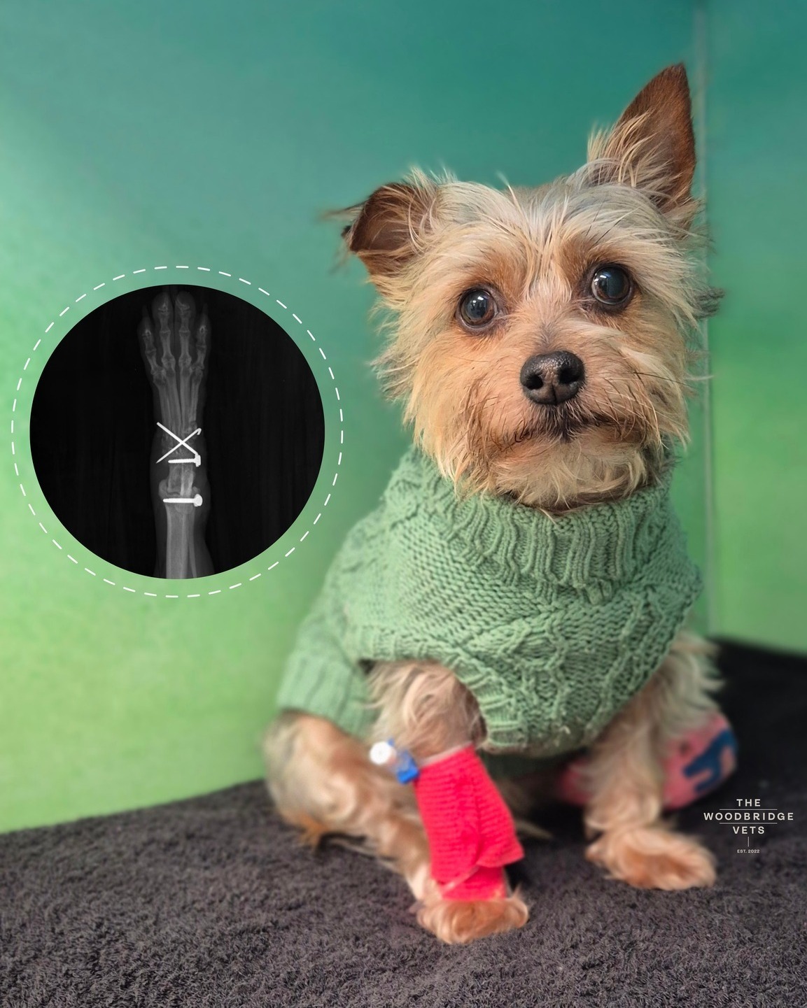 Meet Peggy 💚
Little Peggy, a brave little 5.5kg Chorkie who usually loves racing the whippets at home, was referred to us by our wonderful colleagues from The Hadleigh Vets after injuring her back leg. Normally the speedy one in the garden, she was suddenly sore and wobbly - but still sweet and trusting with everyone caring for her.
Examination and x-rays showed a fracture of a tarsal bone, and suspected rupture of the medial collateral ligament, all contributing to significant instability. Given the severity of the injury, our vets Laurie and Simon proceeded with surgery under general anaesthetic and an epidural for optimal pain control.
They carefully debrided the damaged cartilage and performed a partial tarsal arthrodesis, stabilising the joint with a small locking plate and screws. Laurie and Simon achieved good fixation and stability on Peggy's leg and her post-operative x-rays confirmed everything was well positioned.
She had 12 weeks of strict crate rest ahead - no racing the whippets for a while - but thanks to the expert care from Laurie, Simon, and the referral from The Hadleigh Vets, Peggy has a stable hock and every chance of getting back to her speedy ways 💚
#thewoodbridgevets #independentvets #independentpractice #veterinarycare #veterinaryservices #veterinarymedice #veterinaryreferral #orhopaedicsurgery #chorkie #veterinarysurgeon #dogs #canine #veterinaryteam