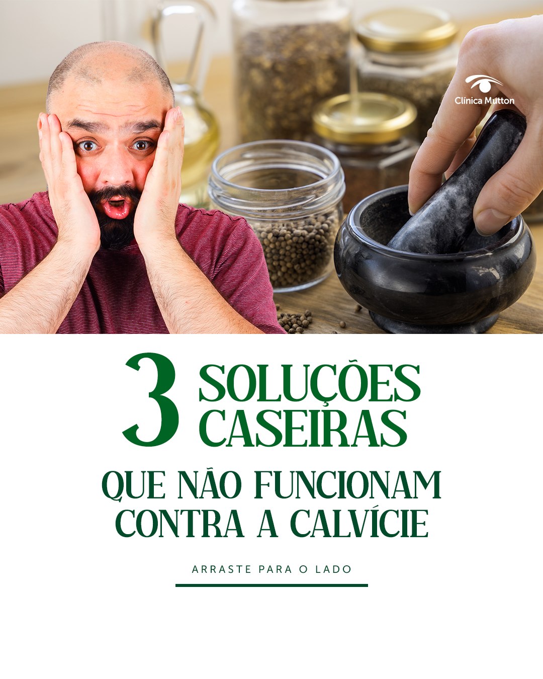 Se você pesquisar, possivelmente vão aparecer várias soluções mirabolantes para calvície. Mas calma lá 🖐
Tem ter muito cuidado com isso, por isso, nada melhor do que se consultar com um médico para saber o tratamento comprovado mais indicado para seu caso!
Enquanto isso, você pode conferir por aqui algumas soluções caseiras que NÃO funcionam para queda capilar. Arraste para o lado e veja!
#dravanessamutton #sorocaba #transplantecapilar #quedacapilar