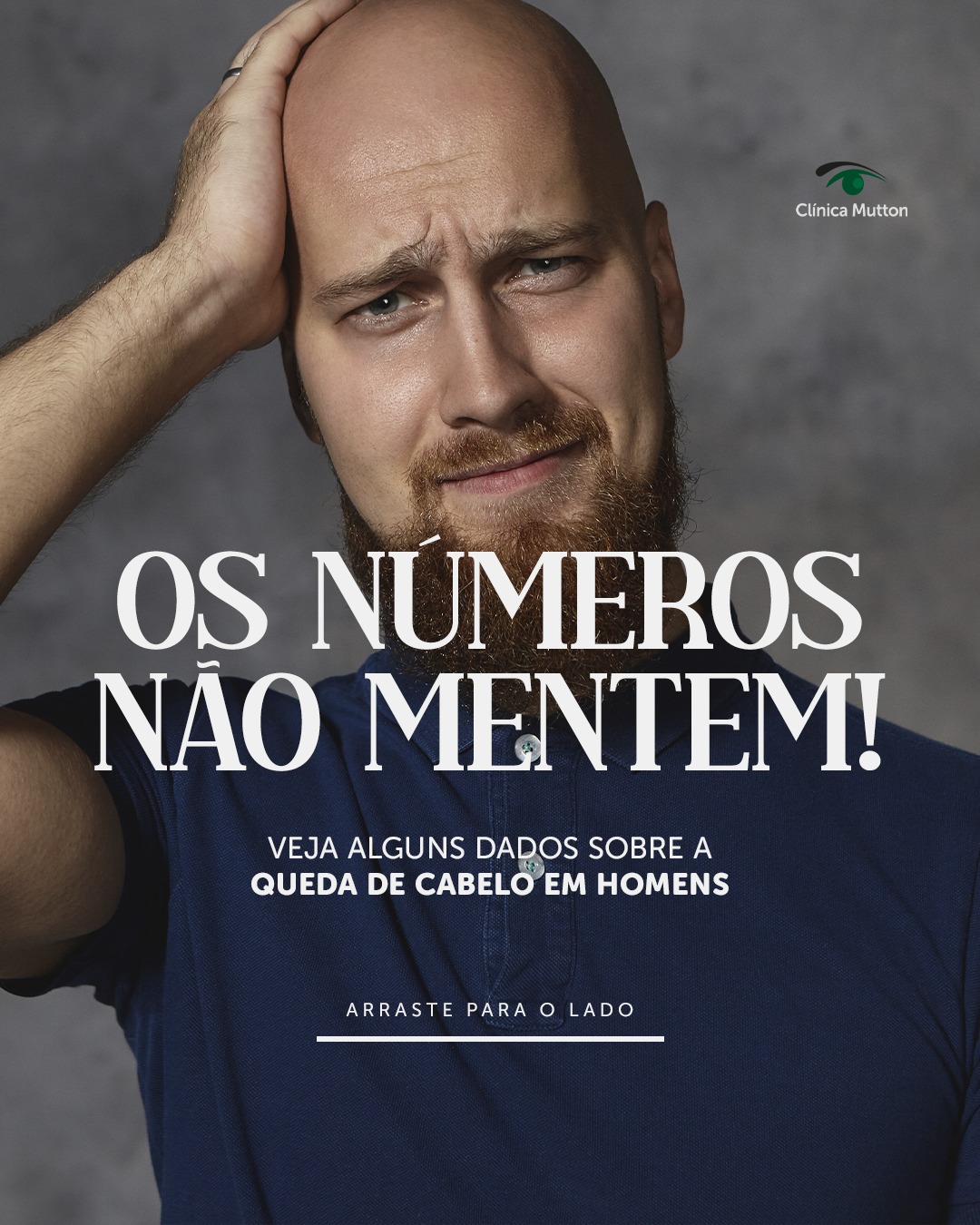 Você provavelmente já notou como muitos homens sofrem com a calvície e, hoje, nós trouxemos alguns dados que provam isso. Arraste para o lado e veja!
#DraVanessaMutton #sorocaba #transplantecapilar #quedacapilar