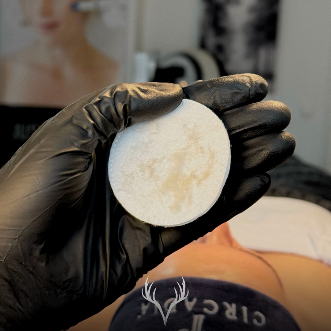 Dermaplaning – unser Lieblings-Add-on für sofortigen Glow ✨🪄
Wenn du dir nach einer Behandlung diesen „polished skin“-Effekt wünschst, ist Dermaplaning eines der schönsten Add-ons überhaupt. Es ist schnell, effektiv und macht einen Unterschied, den man sofort sieht und fühlt:
• die Haut wirkt glatter und strahlender
• Make-up sitzt ebenmäßiger (kein „cakey“ Look)
• deine Heimpflege kann intensiver wirken, weil sie gleichmäßiger aufgetragen wird
• das Hautgefühl: baby smooth 🤍
Wir können Dermaplaning zu fast jeder Gesichtsbehandlung kombinieren – und ehrlich: es sitzt einfach in unserem Herzen. Es ist eines dieser Add-ons, die wir super gern empfehlen, weil der Effekt so clean und sofort sichtbar ist.
Wann Dermaplaning nicht passt (Kontraindikationen) 🚫
Bei bestimmten Hautzuständen verzichten wir bewusst darauf, z. B.:
• aktive Akne / starke entzündliche Unreinheiten
• Rosazea / starke Couperose-Schübe
• offene Stellen, frische Verletzungen, Herpes
• sehr irritierte/geschädigte Hautbarriere oder Sonnenbrand
• direkt nach sehr intensiven Peelings oder wenn die Haut stark überreizt ist
Aber keine Sorge: Wenn Dermaplaning bei dir nicht sinnvoll ist, finden wir andere großartige Add-ons, die besser zu deiner Haut passen – und dich genauso weiterbringen. ✨
Wenn du Dermaplaning in Baden ausprobieren möchtest: Wir beraten dich ehrlich, ob es heute das richtige Upgrade ist – damit es nicht nur schön, sondern auch hautgesund ist.
📍 Beauty Bar Baden – Dermaplaning Add-on
📞 Termine telefonisch oder über unser Online-Buchungstool
#dermaplaningbaden #dermaplaning #glowtreatment #facialbaden #kosmetikbaden #beautybarbaden #badenbeiwien #hautroutine #makeuptipps #skincarewirkung #hautgesundheit #softskin #selfcarebaden #skintreatment #beautyadd on