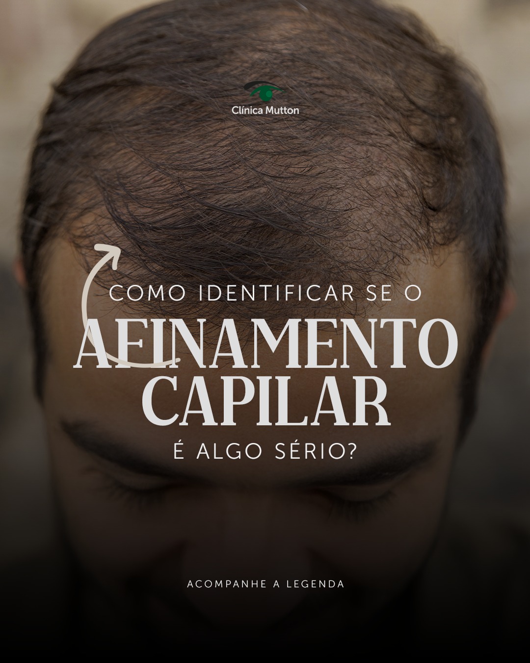Cabelos mais finos, couro cabeludo mais aparente, falhas e entradas surgindo?
Esses podem ser sinais de que o afinamento capilar está indo além do normal e é hora de acender o alerta.
Muitas pessoas só percebem que algo está errado quando a perda de volume já compromete a autoestima. A verdade é que o afinamento pode ter causas hormonais, genéticas, nutricionais, emocionais… e quanto antes for investigado, maiores as chances de manter os folículos vivos e recuperar a densidade dos fios.
Aqui na clínica, avaliamos cada caso com profundidade, tecnologia e empatia, para tratar a causa real do afinamento e não apenas os sintomas.
Se você notou que seus fios estão mais finos, frágeis ou ralos, agende uma consulta. Vamos entender juntos o que está acontecendo com sua saúde capilar e cuidar disso com seriedade.
📲 Agendamentos pelo link da bio.
#DraVanessaMutton #transplantecapilar #sorocaba #afinamentocapilar
