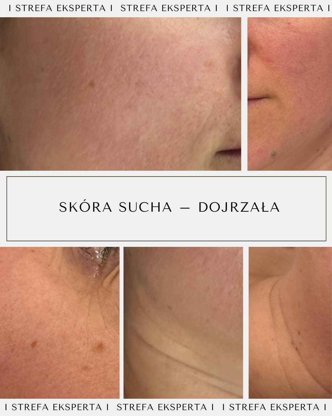 Skóra sucha i dojrzała – kiedy pielęgnacja przestaje być oczywista
Uczucie ściągnięcia mimo kremu, szorstkość, utrata blasku i trudność w doborze kosmetyków?
Sucha skóra dojrzała to nie tylko kwestia komfortu, ale realnych zaburzeń bariery hydrolipidowej, zwiększonej utraty wody i postępujących oznak starzenia.
W tej karuzeli krok po kroku pokazujemy:
• jak rozpoznać suchą skórę dojrzałą,
• jakie objawy najczęściej zgłaszają klientki,
• dlaczego same zabiegi gabinetowe to za mało,
• jak wygląda przemyślany plan zabiegowy marki LVY,
• oraz jak powinna wyglądać codzienna, świadoma pielęgnacja domowa.
Poruszamy też ważne fakty i mity – bo skóra sucha i odwodniona to nie zawsze to samo, a promieniowanie UV potrafi latami sabotować efekty naszej pracy.
Pamiętaj: regularność, odpowiednio dobrane rytuały domowe i wsparcie specjalisty to fundament zdrowej, promiennej skóry – niezależnie od wieku.
Przesuń i sprawdź, jak wygląda kompleksowe podejście do skóry suchej i dojrzałej.
@monika_michalowicz
