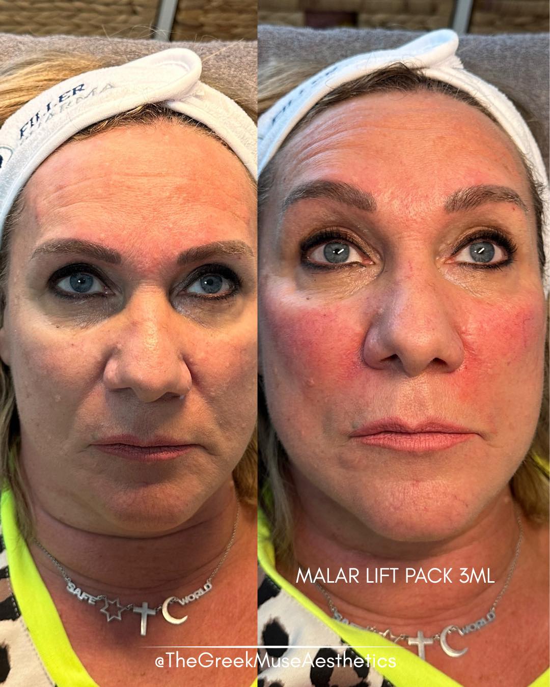 ✨ Malar Lift with 3 ML — structural rejuvenation, not just volume
This treatment focused on restoring support rather than simply adding filler. Using 3 ml, we treated strategic areas to soften the ligament line and rebalance mid-face proportions.
Treatment approach:
• Piriform fossa support: restores deep structural foundation and reduces shadowing around the nasolabial area.
• Cheek (malar) projection: enhances midface support and lifts surrounding tissues.
• Ligament line softening: by supporting adjacent zones, the line appears less visible without directly overfilling it.
• Harmony over volume: the goal is lift, contour, and balance — not puffiness.
💉 Strategic placement changes everything.
📐 Structure first, volume second.
📍 France • Greece
🔗 booking & réservation en bio
#malarift #midfacelift #dermalfiller #aestheticmedicine #facialbalance #injectables #cheekfiller #naturalresults #facialrejuvenation #advancedaesthetics