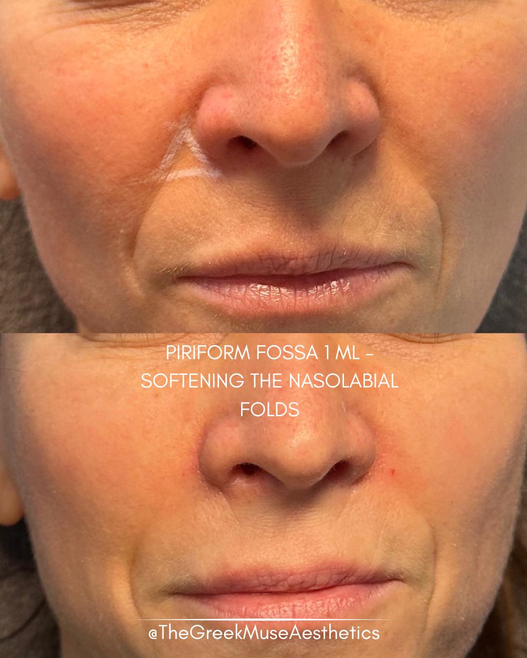 ✨ Piriform fossa treatment — the real key to fresher nasolabial folds
When patients say they dislike their nasolabial folds, it’s often not the fold itself that bothers them.
What actually creates the “tired” look?
• The shadow near the nose: that small hollow beside the nostril (piriform area) is what creates a fatigued appearance.
• Not the fold line: the line toward the mouth can even be charming and expressive.
• Volume loss = shadow: when structural support decreases, light hits differently and the hollow looks darker.
• Targeted correction: restoring volume in the piriform fossa softens the shadow, which naturally refreshes the whole midface.
💉 Treat the cause, not just the visible line.
✨ Subtle support can instantly make a face look more rested and youthful.
📍 France • Greece
🔗 booking & réservation en bio
#piriformfossa #nasolabialfolds #facialanatomy #aestheticmedicine #dermalfiller #naturalrejuvenation #midface #injectables #facialbalance #advancedtechnique