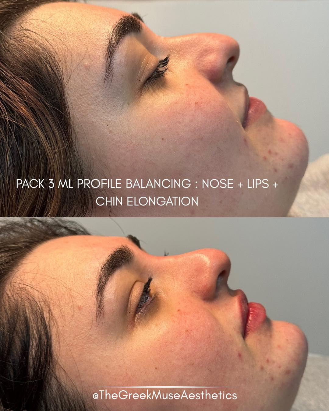 ✨ Profile balancing with 3 ml — harmony through proportions
This treatment focused on full profile refinement using 3 ml strategically distributed to balance facial features rather than changing them.
Treatment plan:
• Nose refinement: the slightly downturned tip was subtly lifted and softened to create a smoother, straighter profile line.
• Lip enhancement: gentle definition to complement the new facial proportions.
• Chin projection & elongation: added structure to the lower face for a more balanced and elegant profile.
• Global harmony: each adjustment was designed to work together, not stand out individually.
💉 True profile balancing isn’t about one feature — it’s about how everything aligns.
📐 Proportions are the secret to natural beauty.
📍 France • Greece
🔗 booking & réservation en bio
#profilebalancing #facialharmony #nonsurgicalrhinoplasty #chinaugmentation #lipfiller #aestheticmedicine #dermalfiller #injectables #naturalresults #advancedaesthetics