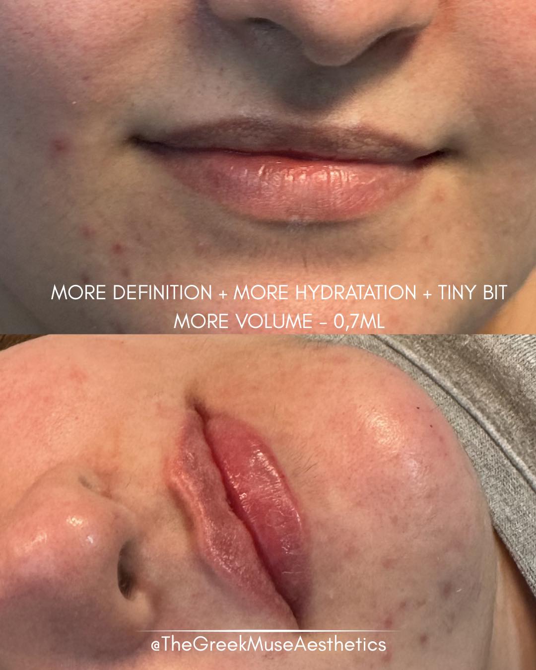 ✨ Heart-shaped lips — created from virgin lips
This client had never had lip filler before and wanted a soft, feminine result with a delicate heart-shaped lip design.
Treatment approach:
• Starting from zero: no previous filler, so the shape was built entirely from scratch.
• Heart-shape design: subtle central volume and contouring created a naturally romantic lip silhouette.
• Balanced proportions: focus on harmony between upper and lower lip.
• Soft finish: smooth texture and hydration for a fresh, youthful look.
💉 First-time lips should always be precise, gentle, and tailored.
💗 Shape matters more than size.
📍 France • Greece
🔗 booking & réservation en bio
#virginlips #heartshapelips #lipfiller #aestheticmedicine #dermalfiller #lipdesign #naturallips #injectables #lipenhancement #advancedaestheticstraining