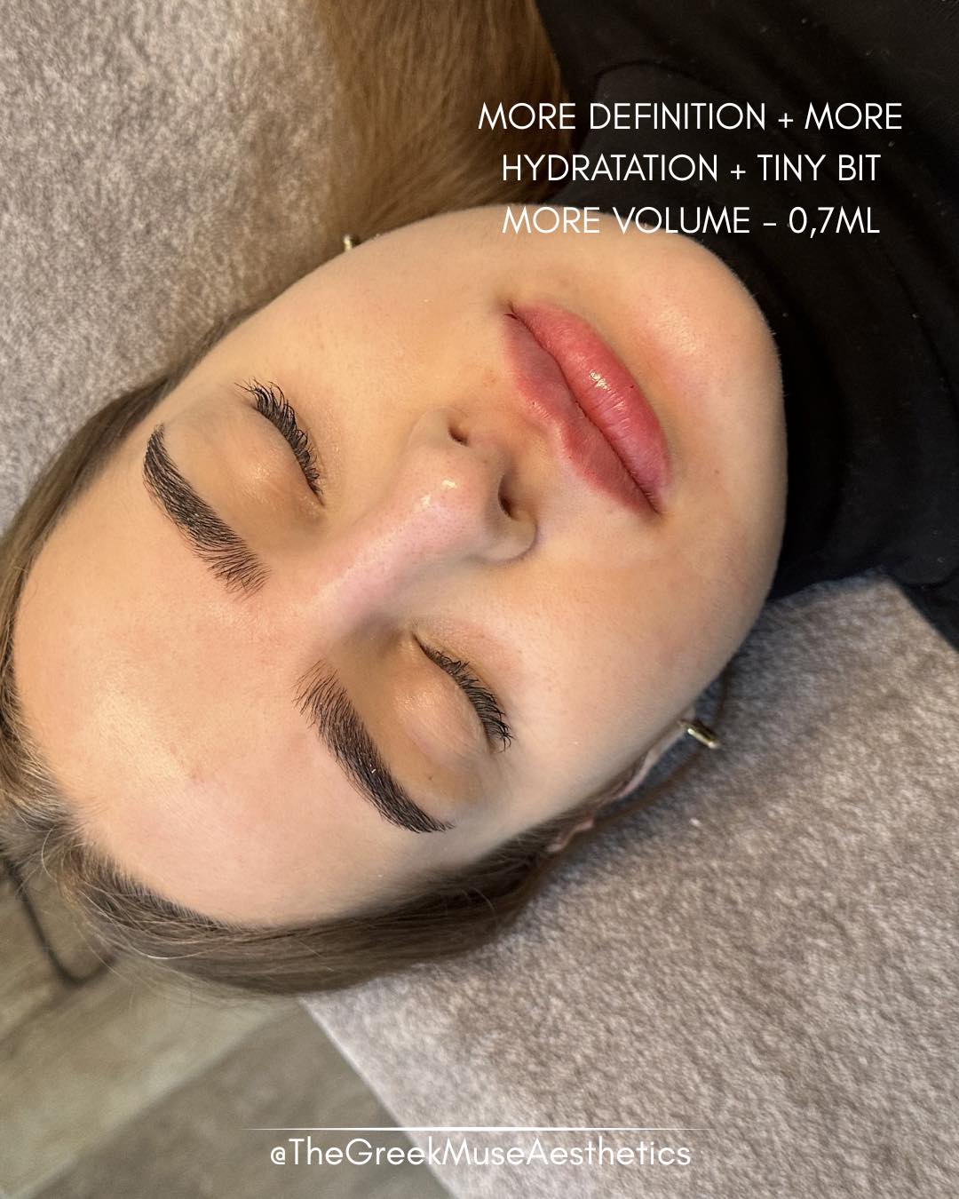 ✨ Enhancing what’s already beautiful — subtle lip refinement
This client already had a naturally beautiful lip shape. She didn’t want a transformation — she wanted a refined version of what she already had.
Treatment focus:
• Shape preservation: the natural contour was maintained, never altered.
• Definition boost: subtle border refinement enhanced the lip outline.
• Hydration effect: hyaluronic acid restored softness and smooth texture.
• Micro-volume: just a touch of volume for balance, not fullness.
💉 Not every lip treatment is about size.
🎯 Sometimes the goal is simply polish, definition, and glow.
📍 France • Greece
🔗 booking & réservation en bio
#lipfiller #naturallips #lipenhancement #aestheticmedicine #dermalfiller #subtleresults #lipdefinition #injectables #beautybalance #naturalbeauty