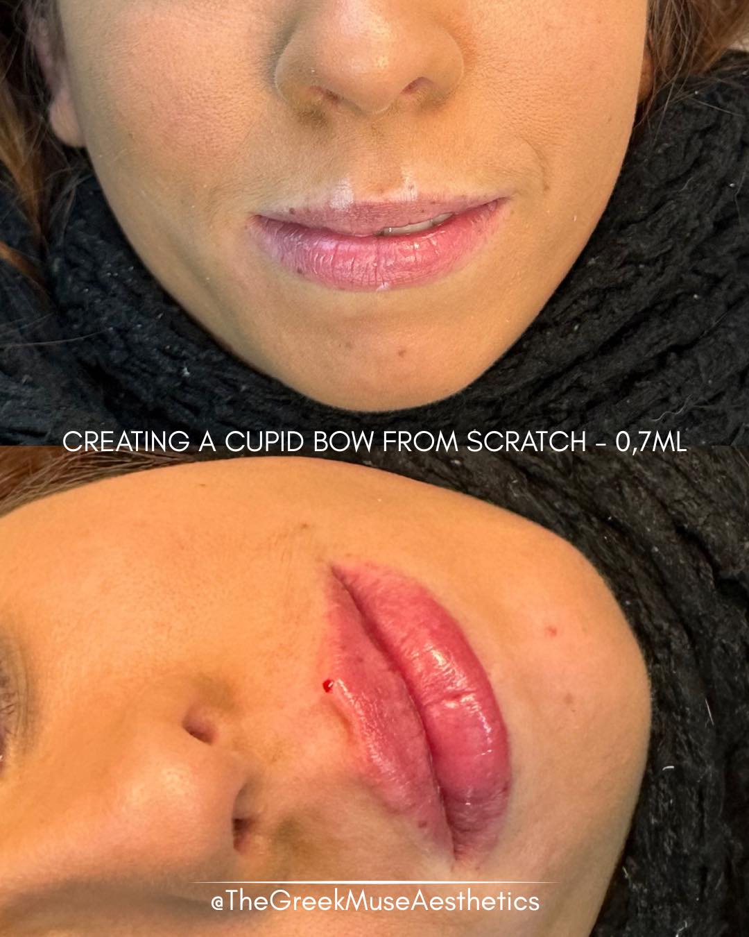 ✨ Russian Lips — rebuilding a Cupid’s bow
This client naturally had no visible Cupid’s bow, which made the upper lip appear flat and less defined. With a tailored Russian lips technique, we were able to sculpt structure and create a beautifully defined shape.
Treatment focus:
• Cupid’s bow reconstruction: carefully built from zero to restore lip architecture.
• Vertical structuring technique: Russian lips allow height and definition without excessive forward projection.
• Precision placement: every injection point contributes to shape, not just volume.
• Defined yet natural: enhanced contours while keeping softness and elegance.
💉 Lip shaping is architecture, not inflation.
📐 Structure is what creates beauty.
📍 France • Greece
🔗 booking & réservation en bio
#russianlips #cupidsbow #liparchitecture #lipfiller #aestheticmedicine #dermalfiller #lipdefinition #injectables #naturallips #advancedtechnique