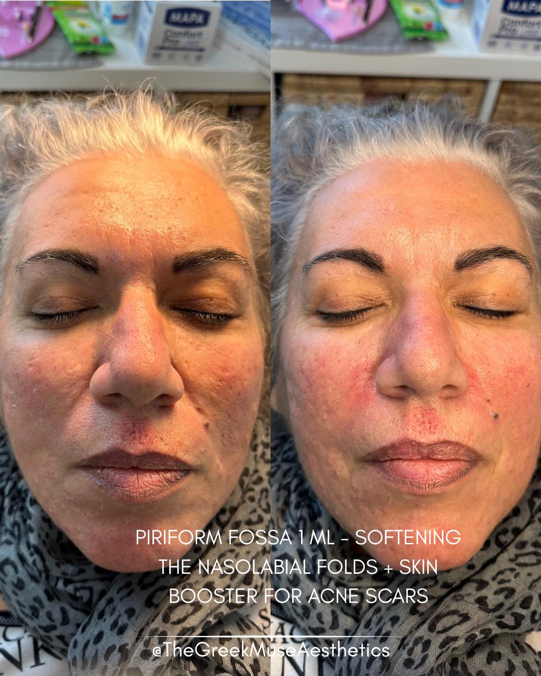 ✨ Piriform fossa + Skin Booster — structure & skin quality combined
For this patient, we combined structural correction with skin improvement to achieve a more complete and natural rejuvenation.
Treatment plan:
• Piriform fossa filler: restored deep support beside the nose to reduce shadowing and soften the tired look.
• Midface refresh: correcting this area can instantly make the face appear more rested and youthful.
• Skin booster for acne scars: targeted hydration and dermal stimulation to improve skin texture.
• Progressive results: skin quality continues improving over the next few weeks, with visible changes expected within a month.
💉 Structure restores support.
💧 Skin boosters restore glow.
📍 France • Greece
🔗 booking & réservation en bio
#acnescars #skinbooster #piriformfossa #aestheticmedicine #skinquality #dermalfiller #facialrejuvenation #injectables #glowingskin #advancedaesthetics