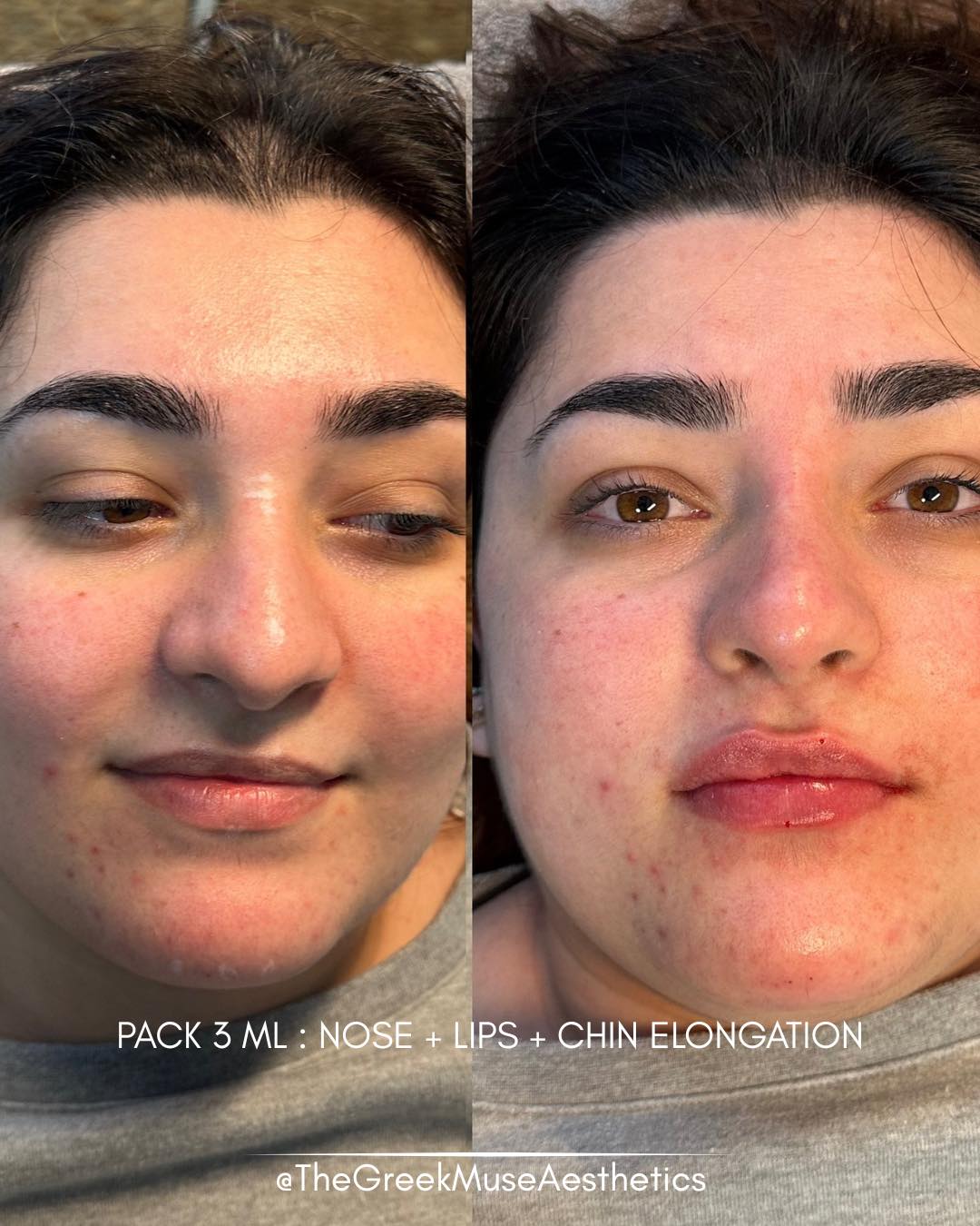✨ Full facial balancing — lips, nose & chin harmony
This patient wanted a more sculpted and refined facial profile while keeping everything soft and natural. Instead of changing one feature, we focused on overall balance.
Treatment approach:
• Chin refinement: slight elongation helped create a more structured and elegant lower face.
• Profile harmony: adjusting projection can make facial contours appear more defined and less rounded.
• Lip enhancement: subtle shaping to complement the new proportions.
• Non-surgical rhinoplasty: gentle refinement to align the profile.
💉 Sometimes the key isn’t adding volume — it’s creating structure.
📐 Harmony between features is what truly transforms a face.
📍 France • Greece
🔗 booking & réservation en bio
#facialbalancing #profilerefine #chinaugmentation #nonsurgicalrhinoplasty #lipfiller #aestheticmedicine #dermalfiller #facialharmony #injectables #advancedaesthetics