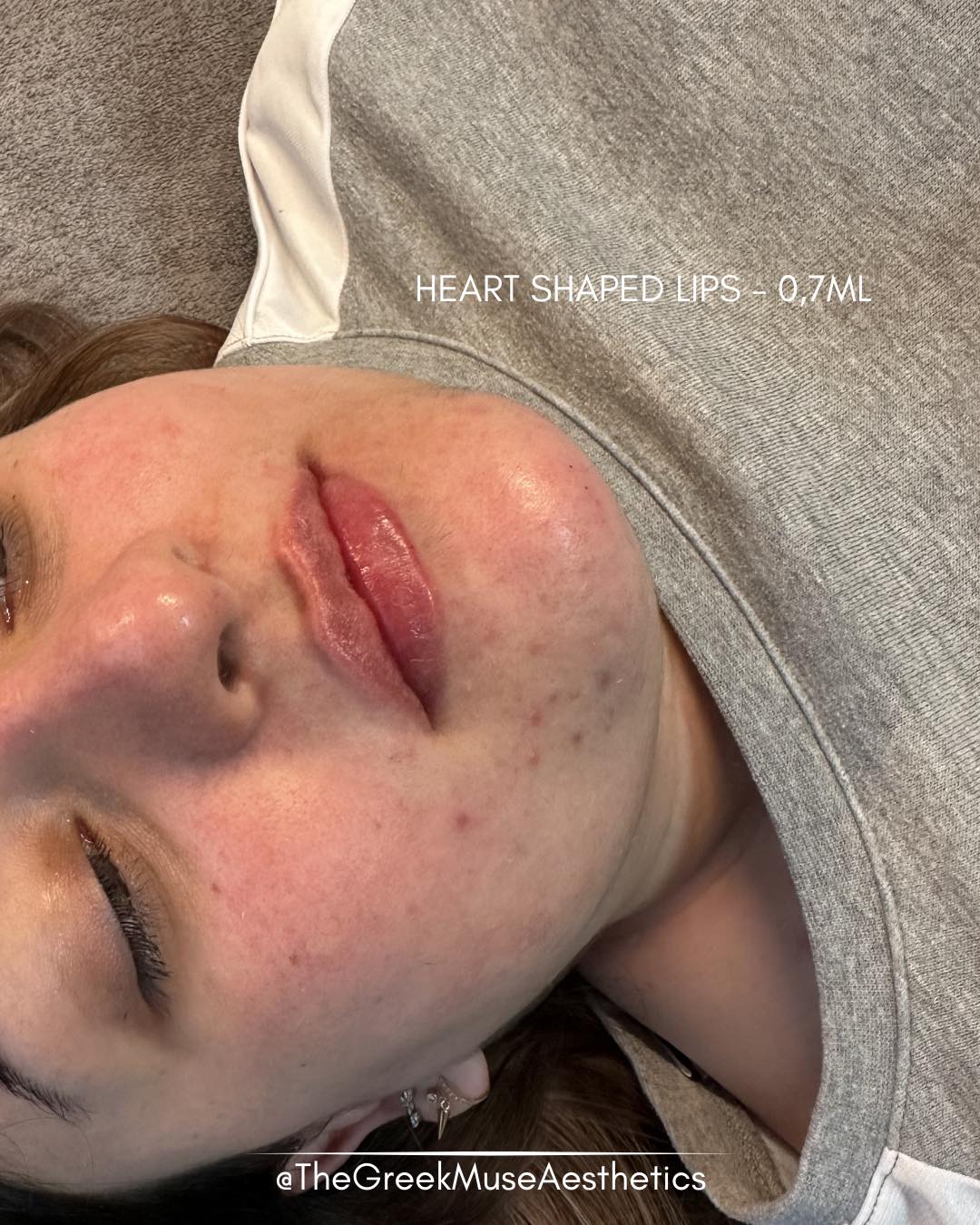 ✨ Heart-shaped lips — created from virgin lips
This client had never had lip filler before and wanted a soft, feminine result with a delicate heart-shaped lip design.
Treatment approach:
• Starting from zero: no previous filler, so the shape was built entirely from scratch.
• Heart-shape design: subtle central volume and contouring created a naturally romantic lip silhouette.
• Balanced proportions: focus on harmony between upper and lower lip.
• Soft finish: smooth texture and hydration for a fresh, youthful look.
💉 First-time lips should always be precise, gentle, and tailored.
💗 Shape matters more than size.
📍 France • Greece
🔗 booking & réservation en bio
#virginlips #heartshapelips #lipfiller #aestheticmedicine #dermalfiller #lipdesign #naturallips #injectables #lipenhancement #advancedaesthetics