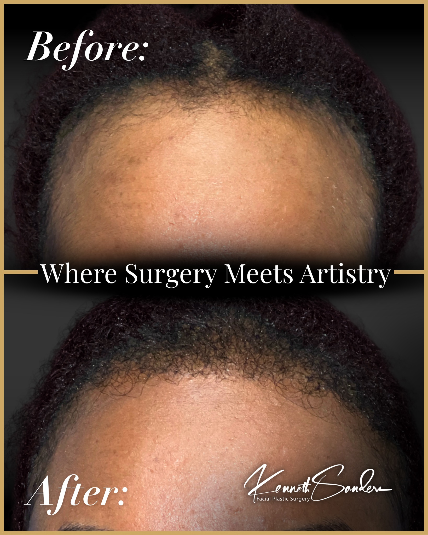 This is what natural hair restoration should look like.
Not harsh. Not obvious. Not “pluggy.” Just a softer, fuller hairline that blends like it was always there.
Hair transplants are about detail. The angle of each graft. The density. The shape of the hairline. It has to look right up close and from across the room.
Dr. Kenneth Sanders approaches hair restoration the same way he approaches the face. Thoughtfully. Artistically. Intentionally.
If you’ve been noticing thinning at the hairline and wondering what your options are, this is your reminder that subtle change can make a big difference.
Call (318) 698-8711 to schedule your consultation in Shreveport.
#HairTransplant #HairRestoration #DrKennethSanders #FacialPlasticSurgeryShreveport #Shreveportbossier