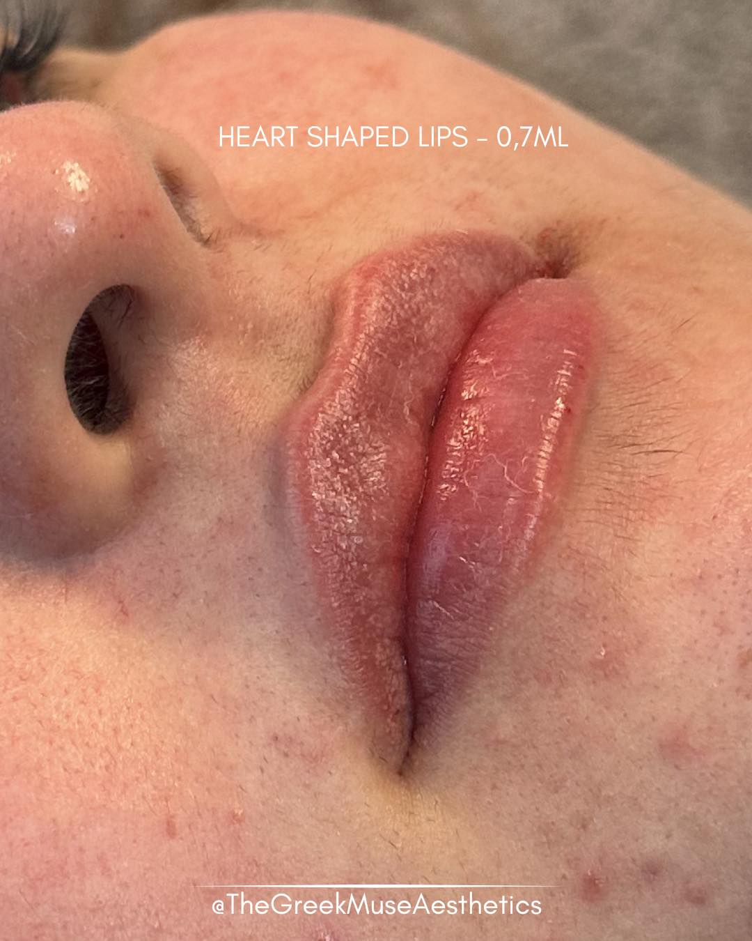 ✨ Heart-shaped lips — created from virgin lips
This client had never had lip filler before and wanted a soft, feminine result with a delicate heart-shaped lip design.
Treatment approach:
• Starting from zero: no previous filler, so the shape was built entirely from scratch.
• Heart-shape design: subtle central volume and contouring created a naturally romantic lip silhouette.
• Balanced proportions: focus on harmony between upper and lower lip.
• Soft finish: smooth texture and hydration for a fresh, youthful look.
💉 First-time lips should always be precise, gentle, and tailored.
💗 Shape matters more than size.
📍 France • Greece
🔗 booking & réservation en bio
#virginlips #heartshapelips #lipfiller #aestheticmedicine #dermalfiller #lipdesign #naturallips #injectables #lipenhancement #advancedaesthetics