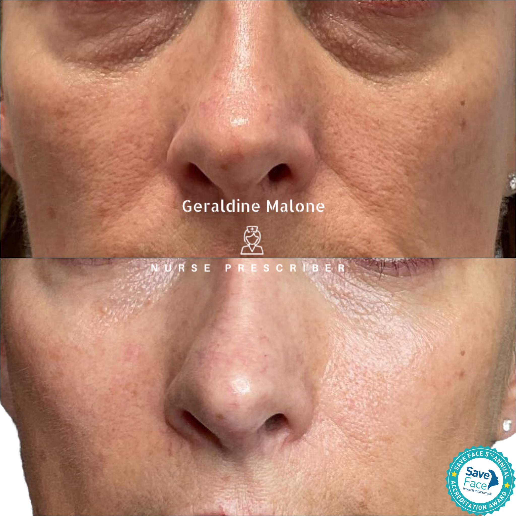 ✨ Polynucleotide Skin Rejuvenation✨
A beautiful improvement in skin quality, hydration and overall radiance 💫
Polynucleotides work at a cellular level to repair and regenerate the skin, stimulating collagen and elastin production for smoother, healthier-looking skin.
💉 Improves fine lines & texture
💧 Deep hydration from within
💆♀️ Enhances skin density and elasticity
✨ Brighter, smoother appearance
All treatments carried out by Nurse Prescriber Geraldine Malone in a Save Face Registered Clinic.
📅 Book your appointment:
👉 www.geraldinemalone.co.uk/book-appointment
📍 CV6 1EB
☎️ 024 7792 1812
📧 geraldinemaloneaesthetics@outlook.com