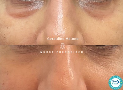 Polynucleotide Eye Rejuvenation ✨
A subtle refresh using Polynucleotides to improve skin quality, hydration, and elasticity around the delicate eye area.
These before & after results show:
• Improved skin smoothness
• Brighter, healthier-looking under-eyes
• Enhanced overall skin quality
Polynucleotides work by stimulating collagen production and supporting tissue repair — perfect for tired, thinning or ageing under-eyes.
Gradual, natural results with minimal downtime.
Treatment carried out by Nurse Prescriber Geraldine Malone in a Save Face registered clinic.
📍 CV6 1EB
📞 024 7792 1812
📧 geraldinemaloneaesthetics@outlook.com