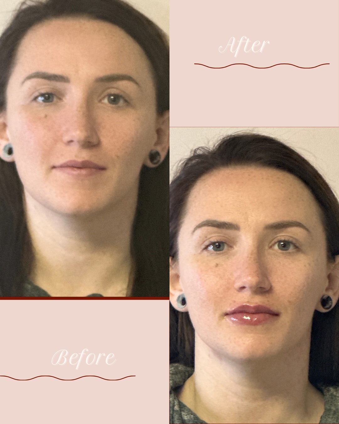 Before ➡️ After
post lip enhancement 💉✨
Soft volume.
Crisp definition.
Balanced shape.
Still her — just elevated.