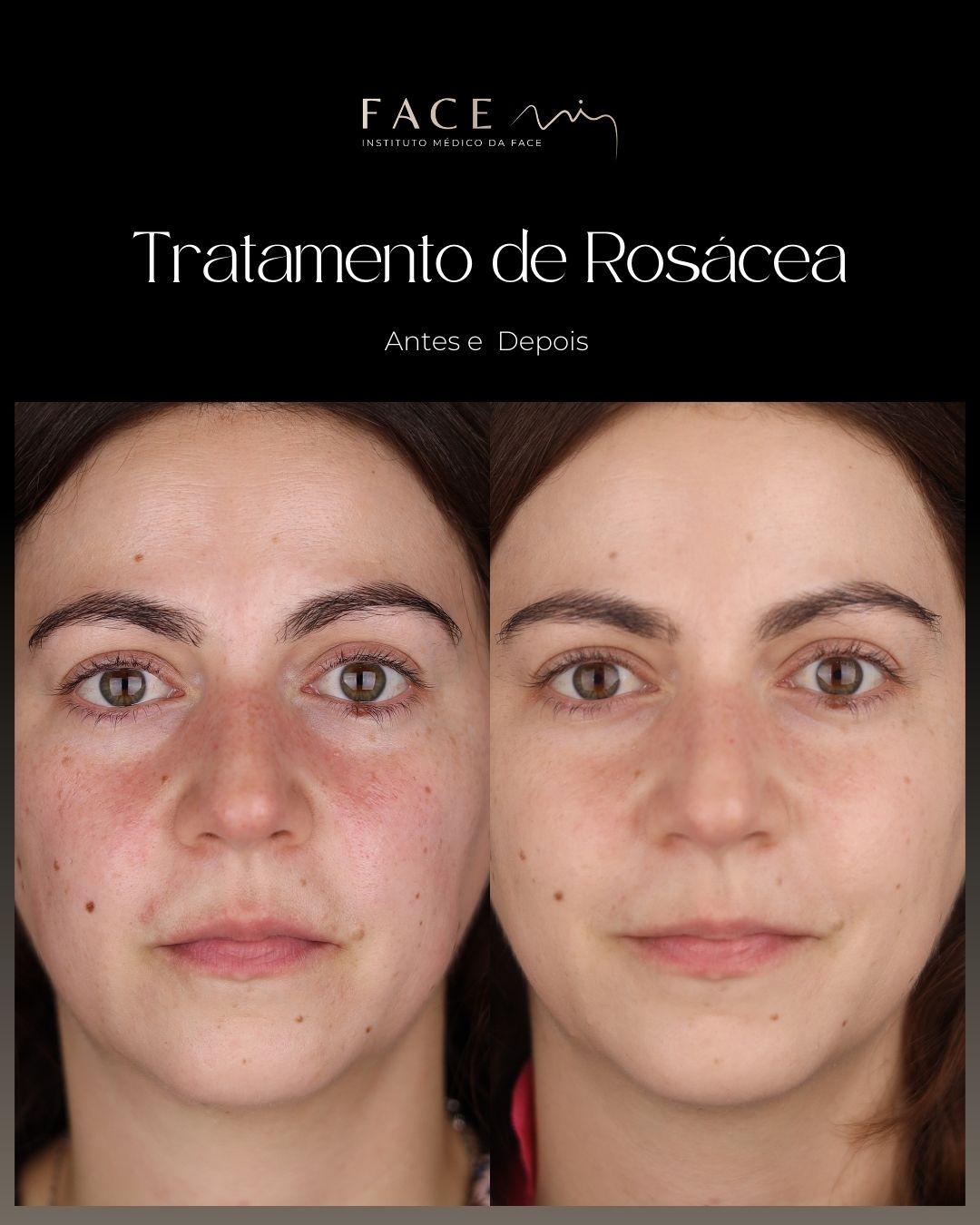 Rosácea tem tratamento.
Com a Luz Pulsada BBL da Sciton, reduzimos a vermelhidão e tratamos os vasos responsáveis pela rosácea.
Resultados progressivos.
Pele mais uniforme.
Mais conforto no dia a dia.
#scitonlaser #skinlasertreatments #lasertreatments #scitonbbl #scitonbblheroic #facemi #facemibraga #facemiporto #institutofacemi #medicinaestetica #medicinaesteticabraga #clinicaesteticabraga #medicinaesteticaporto #clinicaesteticaporto
Os casos clínicos apresentados refletem o antes e depois de pacientes específicos que deram o seu consentimento para serem apresentados nos canais e redes sociais do Instituto Face Mi. Cada pessoa é única e o resultado pode variar de paciente para paciente.
Todos os pacientes, antes de cada procedimento, passam por um processo de consulta médica de diagnóstico onde são avaliadas indicações, expectativas e motivações.
Registo ERS: 21236
Registo estabelecimento: E159774
Licença funcionamento: 21236/2022