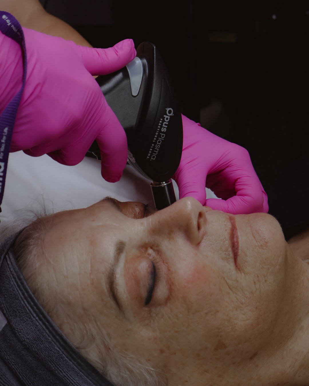 3 reasons eye area ages faster
The skin around your eyes is built different. It is thinner, it moves all day, and it gets more “wear and tear” than most areas.
————————
☀️ Sun exposure
The eye area catches UV even on quick school drop offs, dog walks, and driving.
🫣 Rubbing and wiping
Makeup removal, allergies, watery eyes, it adds up fast.
😴 Sleep and pressure
Side sleeping, face into the pillow, and repeated compression can show up as texture and lines over time.
————————
Which one surprised you most 😳
If your goal is a firmer look around the eyes, Opus is one option we use because it creates controlled micro treatment points that trigger collagen renewal.
Think you might be a fit? Send us a message and we’ll point you in the right direction.
————————
Smooth Secret RN 💋 It’s our Secret
Jo-Lynn Gibbs RN, BScN + Pailey Corbett RN, BScN
#SherwoodParkAesthetics #SkinResurfacingSherwoodPark #OpusPlasma