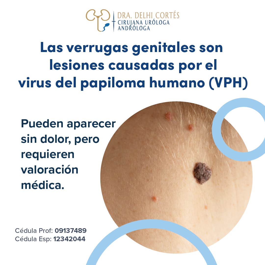 Este Día Internacional de Concientización sobre el Virus del Papiloma Humano.
Detectar y tratar a tiempo las verrugas genitales ayuda a evitar complicaciones.
Agenda una consulta y cuida tu salud íntima 🩺📅
📲: 5612133757
📍 Torres Médicas Angelópolis (Torre 1). Piso 12, Consultorio 1229. Puebla