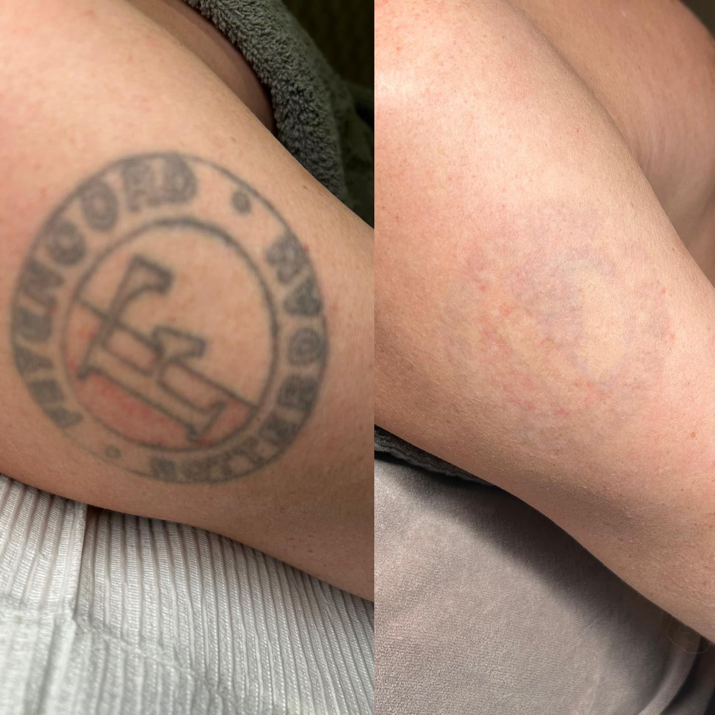 Spijt van je Tattoo?
Maak een afspraak voor een gratis intake gesprek en proefbehandeling.
Dan helpen wij je veilig en effectief van je tatoeage af.
Dit was het resultaat al na slechts 4 behandelingen, te mooi om niet te delen!
Uiteraard gaat deze klant nog verder om het laatste waasje te verwijderen.
#schoonheidssalonwilmameins #centrumveendam #langmairpicolaser #picolaser #liefzijnvoorjezelf