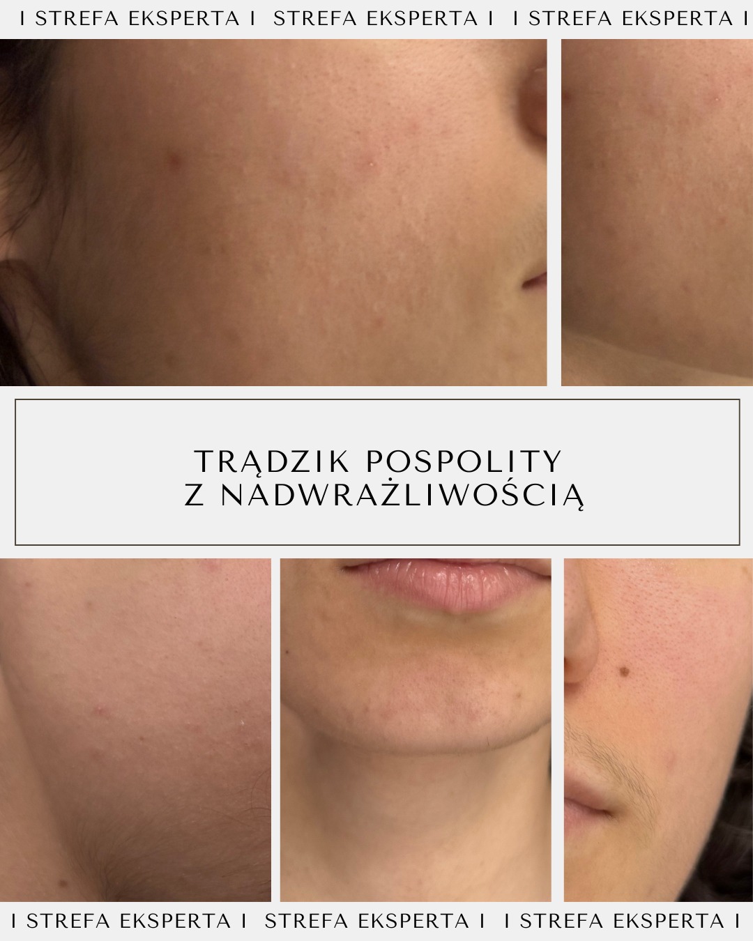 Trądzik pospolity z nadwrażliwością to nie tylko kwestia wykwitów — to złożony problem bariery skórnej, nadreaktywności i nieprawidłowej pielęgnacji.
Zaburzona bariera hydrolipidowa, rumień, nadprodukcja sebum i jednoczesne przesuszenie wymagają precyzyjnej diagnostyki oraz etapowego planu zabiegowego, a nie agresywnych „wysuszających” rozwiązań.
Kluczem do poprawy jest połączenie terapii gabinetowej, indywidualnie dobranej pielęgnacji domowej oraz konsekwencji w działaniu — tylko wtedy skóra ma realną szansę na równowagę i długofalową poprawę jakości.
ZALECENIA PIELĘGNACJI DOMOWEJ:
KROK 1. Oczyścić skórę za pomocą pianki HYDRA CLENASER MOUSSE – rano, a wieczorem za pomocą żelu HYDRA CLEANSER PERFECT.
KROK 2. Rano zaaplikować krem LIGHT AGAIN, a wieczorem serum MBS – pozostawić na 5 minut, a następnie zaaplikować krem BIO REPAIR.
KROK 3. Każdego wieczoru po nałożeniu pielęgnacji – odczekać ok. 10 minut, a następnie zaaplikować za pomocą patyczka higienicznego – na wykwity – leczniczą maskę – BALANCE TARGET – pozostawić do rana.
KROK 4. Rano i wieczorem zaaplikować na okolicę oka serum – LOOK Eye Contour
@monika_michalowicz