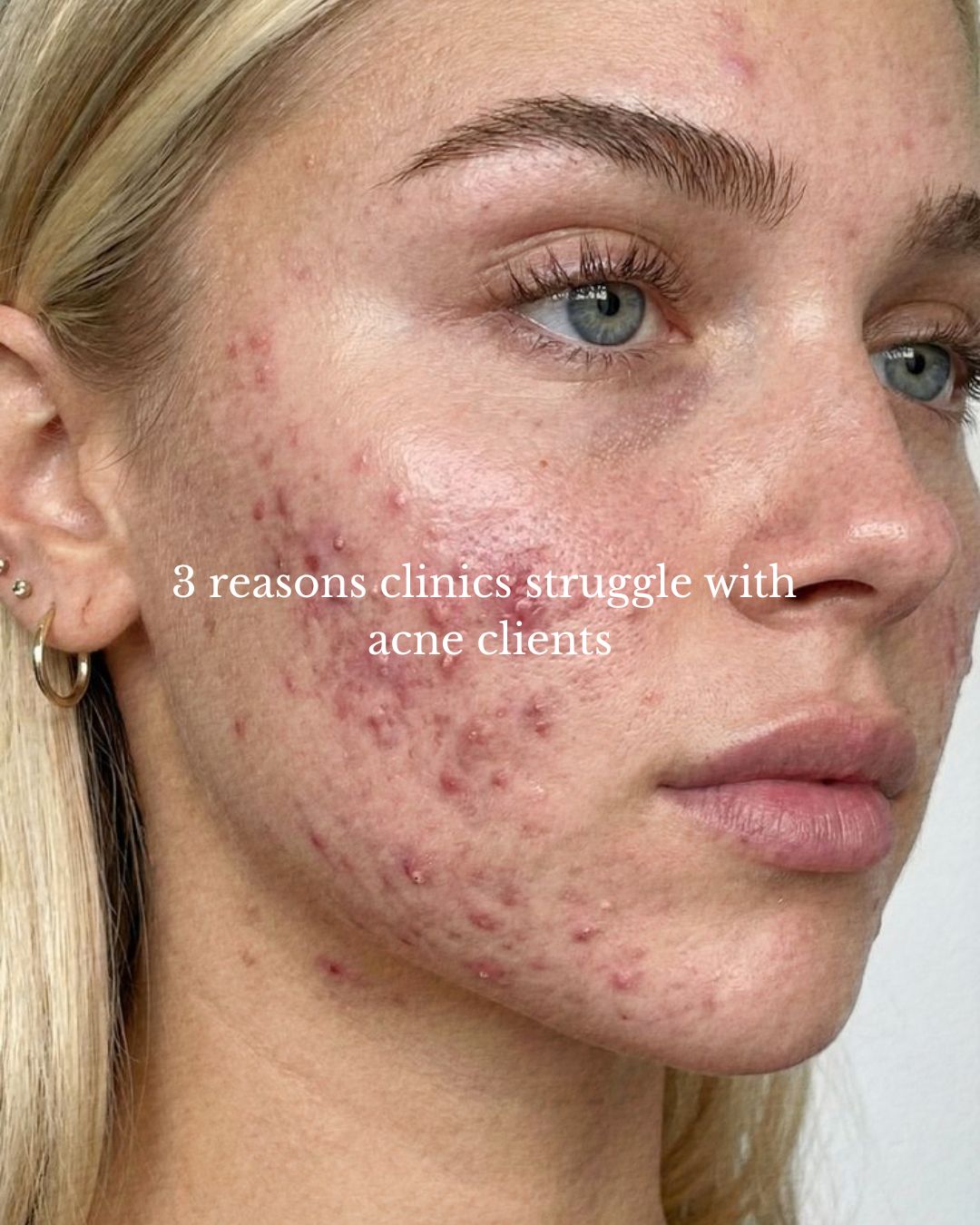 Skin revision focuses on the underlying cause of skin conditions and for acne, that means looking deeper than the breakout. 🔍
Most acne treatments focus on drying out the surface, but that often leads to a compromised barrier and more inflammation. With DMK, we don't just "attack" the spot; we address the dysfunctional skin factory that created it.
By removing dead cell buildup, regulating oil production, and flushing out toxins via Enzyme Therapy, we create an environment where acne simply can't survive. We aren't just clearing your skin; we’re revising how it functions.