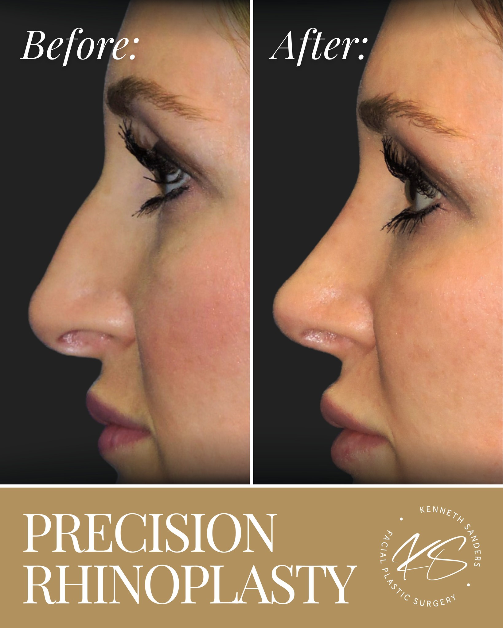 A little refinement can make a big difference
In this rhinoplasty, Dr. Sanders focused on smoothing the dorsal hump and refining the profile to create a softer, more balanced look while keeping everything natural and harmonious with the rest of the face.
Thatâs the art of great rhinoplasty. It shouldnât look like a different nose. It should look like the nose that was always meant to be there.
If youâve been curious about rhinoplasty, the first step is a consultation where we can talk through your goals and whatâs possible.
đ Call (318) 698-8711 to schedule.
#Rhinoplasty #FacialPlasticSurgery #nosejob #ProfileBalance #ShreveportBossier