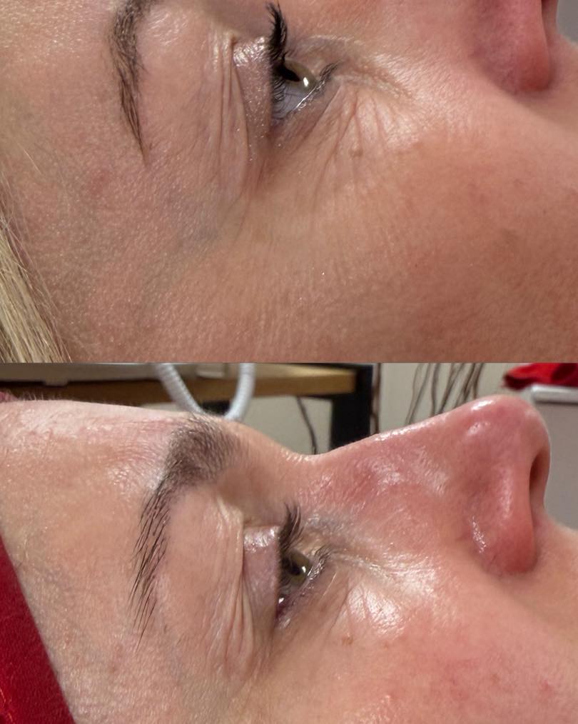 Soin du regard liftant de la marque Guinot chez BELLAMY BEAUTY ✨
Avant/Après Soin « Eye lift » .
#vitryenartois
#esthetique
#esthetiqueprofessionnelle
#salondebeaute