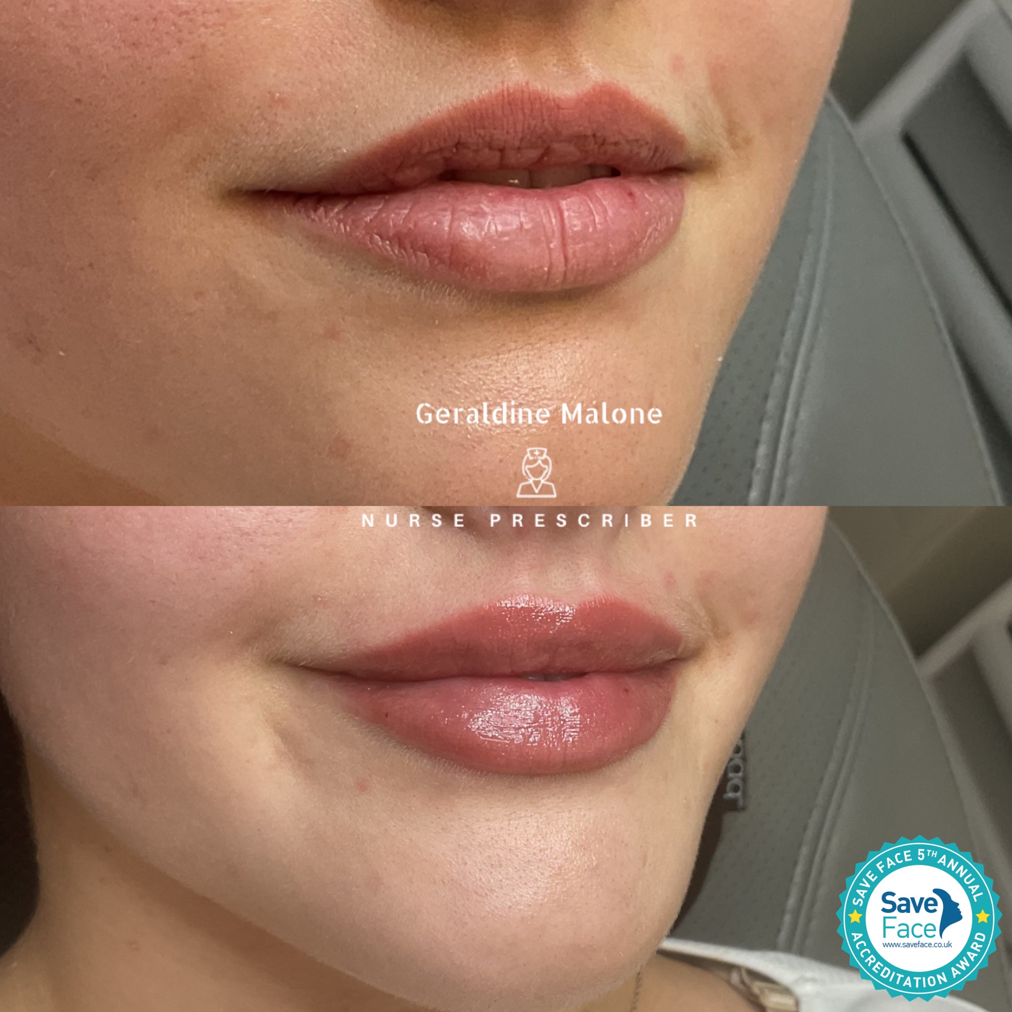 ✨ 0.5ml Lip Enhancement
A refined lip enhancement achieved with 0.5ml of dermal filler, adding gentle volume and definition while preserving the lips’ natural shape.
💉 0.5ml £145 | 1ml £225
⏱ Recovery: 24–48 hours
⏳ Results last: 6–12 months
✔️ No edited images — real results only
Performed by Nurse Prescriber Geraldine Malone in a
Save Face Registered Clinic
📅 Book your appointment:
👉 geraldinemalone.co.uk/book-appointment
📞 024 7792 1812
📧 geraldinemaloneaesthetics@outlook.com