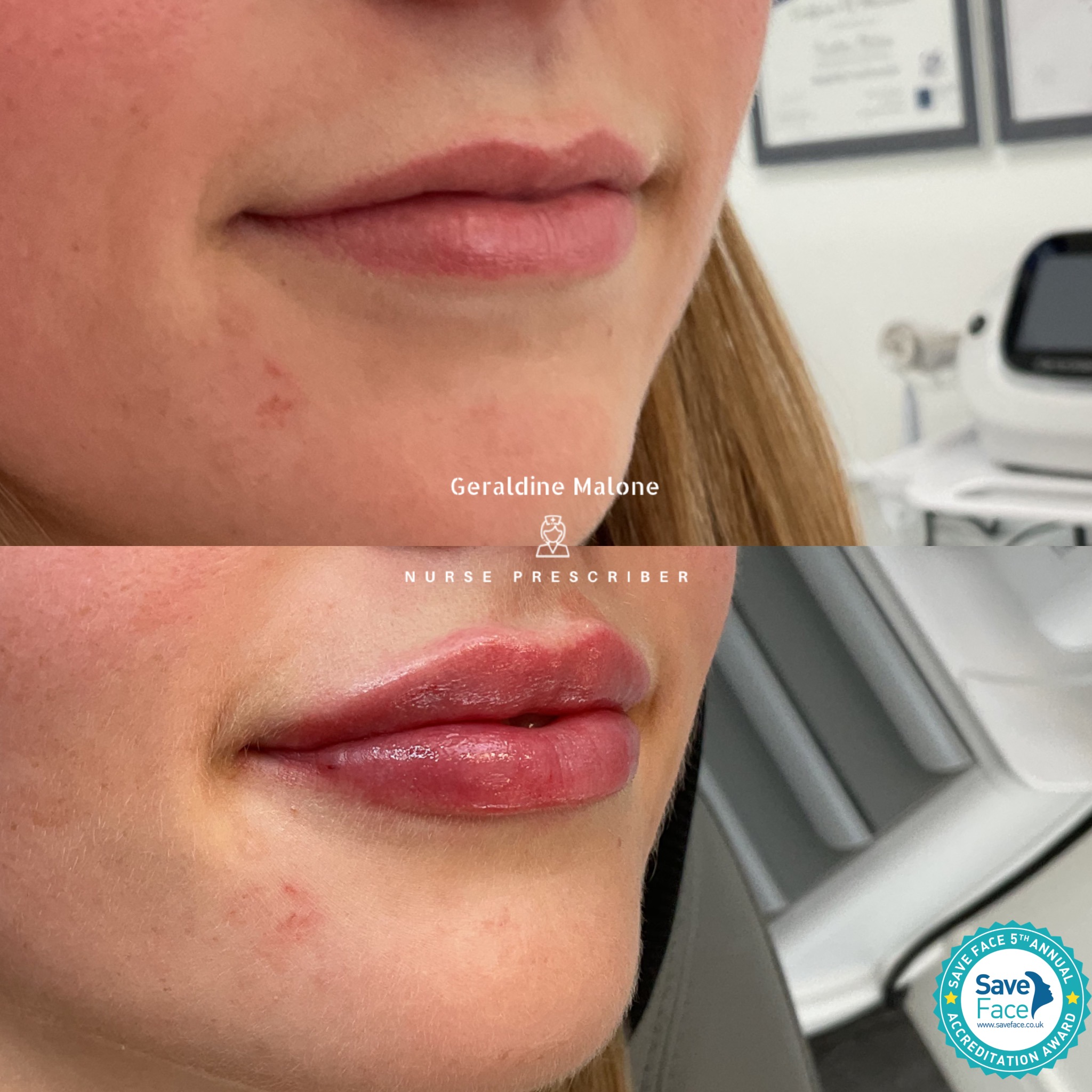 ✨ 1ml Lip Enhancement
A beautifully natural result achieved with 1ml of dermal filler, adding subtle volume, definition and improved lip symmetry while maintaining a soft, natural shape.
💉 0.5ml £145 | 1ml £225
⏱ Recovery: 24–48 hours
⏳ Results last: 6–12 months
✔️ No edited images — real results only
Performed by Nurse Prescriber Geraldine Malone
Save Face Registered Clinic
📅 Book your appointment:
👉 geraldinemalone.co.uk
📞 024 7792 1812
📧 geraldinemaloneaesthetics@outlook.com