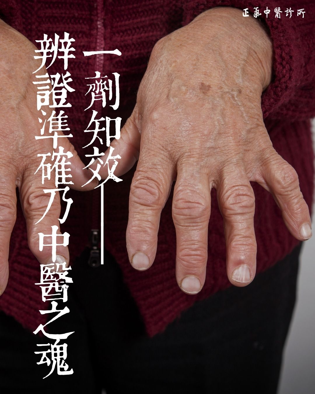 一次同學相聚,一堂生動的“辨證論治”課🩺
1月28日,一位老同學帶來了一個令人揪心的消息。她被確診為類風濕關節炎,病情來勢洶洶:右手關節,特別是手指,紅腫熱痛到無法彎曲,連膝關節也出現酸痛。伴隨而來的,還有困擾她多年的口乾口苦、眼睛乾澀疼痛。
為了治病,她在深圳龍崗中心醫院看了2位主任醫師,服用中西藥,效果不佳。在熟人的引薦下,才好不容易掛上了廣東省中醫院某專家的加號。專家為她開出的中西藥,甚至開了一些“特效藥”。然而,滿懷希望的她,等來的不是病情的好轉,而是更沉重的打擊——服藥後,關節症狀不僅沒有減輕,反而加重,還新添了滿口的潰瘍和渾身的無力感 ,眼睛澀痛到發紅。身體的痛苦加上求醫無果的焦慮,讓這個春節蒙上了陰影。
正月初四,得知我正在放假,她夫婦特意從饒平趕來與我相聚。既是老友重逢,也是病急求醫。當晚,我便為她切脈問診,並根據四診合參,為她進行了一次針灸治療,同時開出了一個處方,讓她回去買3劑試試,並告知其中含有大黃15克,預計會有通便的效果。
驚喜,在昨天早上就傳來了。她發來信息說:“阿華,報告好消息!第一包藥吃完,馬上就感覺嘴巴很舒服,手上的腫脹也消了很多。現在我正在煮第二包。” 但同時她也提到,吃了藥後還沒有大便,更沒有出現拉肚子的情況。
這個回饋讓我陷入了思考。按常理,15克大黃應當有瀉下之力,未出現預期反應,或許與藥材品質有關。但更觸動我的,是這件事背後折射出的深刻問題:為什麼專家開出的藥,反而讓她病情加重、口腔潰瘍?而我的方子,僅僅一劑就讓她感覺“嘴巴舒服、手消腫”?
答案,或許就藏在“辨證論治”這四個字裡。
她的口乾口苦、眼乾澀痛,以及關節的紅腫熱痛,都是典型的“熱象”,病在少陽經。之前的專家治療,可能只看到了類風濕“痹症”的表像,而未能精准識別其“濕熱內蘊,病在少陽”的本質,用藥或有偏頗,甚至可能誤用了溫燥之品如炮附子,麻黃等藥,導致火上澆油,熱毒上攻而發為口瘡。我的方子之所以見效,並非醫術比專家高明,而是在那一刻,通過切脈問診,抓住了她當下“濕熱阻滯經絡、津液不能上承,病在少陽”的核心病機。無論是針灸疏通經絡,還是中藥清熱利濕,疏肝利膽,都正好對證,所以效果立竿見影。
這次經歷,對我而言,也是一堂深刻的臨床課。它再次印證了:在中醫面前,沒有絕對的“專家”,只有對證的“良方”。 即便是享譽盛名的專家,如果辨證稍有偏差,用藥失之毫釐,療效便會謬以千里。而對於患者來說,無論求醫之路多麼艱辛,找到那個能精准把握你當下身體狀態的“明白人”,才是走出病痛陰霾的關鍵。
這件事讓我更加堅信,我們手中的三根手指,不僅要摸清脈象的虛實,更要守住對生命個體差異的敬畏之心。辨證準確,用藥精當,方為中醫之魂。
馬志華醫師
2026年2月24日
#疑難雜症 #中醫內科 #兒科 #婦科 #皮膚科 #腫瘤科 #眼科 #針灸 #艾灸 #拔罐 #放血療法 #北角 #炮台山 #類風濕關節炎 #正氣中醫診所 #關節痛 #關節炎 #痛症 #眼睛乾澀 #乾眼症 #濕熱 #類風濕 #醫案分享 #從醫心得