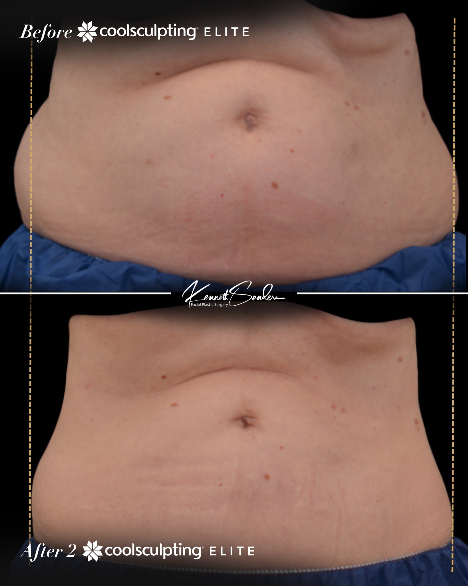 Stubborn fat that just⌠wonât budge? Thatâs where CoolSculpting shines.
CoolSculpting Elite is an FDA-cleared treatment that freezes fat cells beneath the skin so your body can naturally eliminate them over time.
And hereâs the best part⌠once those fat cells are gone, theyâre gone for good. They donât come back in the treated area.
Weâre talking about the spots that ignore your workouts. Lower abdomen, flanks, thighs, under the chin.
No surgery. No downtime. Just a more sculpted look that actually lasts.
If youâve been thinking about it, this is your sign. Call (318) 698-8711 to schedule your FREE body assessment.
#CoolSculpting #Shreveport #DrKennethSanders #CoolSculptingElite #BodyContouring