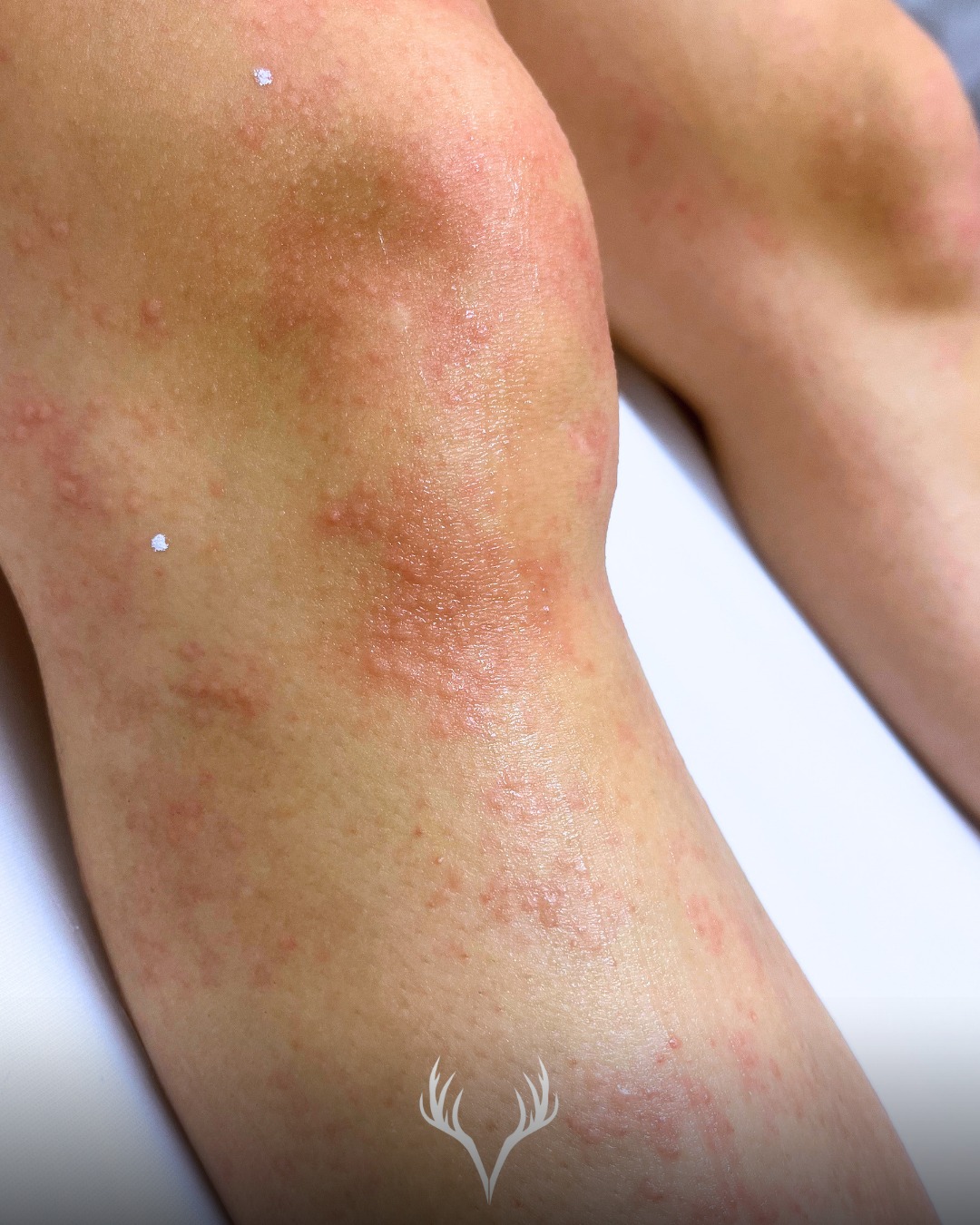 Der beste Zeitpunkt für Laserhaarentfernung?
👉 Jetzt – im Frühling ✨🌿
Warum? Weil du deinem Körper genau die Zeit gibst, die er braucht, um Ergebnisse aufzubauen – und gleichzeitig schon im Sommer davon profitierst ☀️
💡 Wichtig zu wissen:
Die Laserhaarentfernung arbeitet in Zyklen – deshalb sind mehrere Sitzungen notwendig, um Haare langfristig zu reduzieren.
ABER:
Das bedeutet nicht, dass du erst am Ende Ergebnisse siehst 👇
✨ Schon ab der ersten Behandlung:
– wachsen Haare langsamer nach
– werden sie feiner und weniger
– musst du deutlich seltener rasieren
Und genau das macht den Unterschied im Sommer:
Du bist vielleicht noch nicht komplett fertig – aber es ist spürbar angenehmer, gepflegter und unkomplizierter 🤍
🌿 Früh starten = entspannt durch den Sommer
Unser Ziel ist nicht nur Haarentfernung –
sondern dir langfristig Freiheit im Alltag zu geben.
📞 Termine telefonisch oder direkt über unser Online-Buchungstool sichern
#laserhaarentfernung #dauerhaftehaarentfernung #glattehaut #beautybaden #badenbeiwien #kosmetikstudio #beautybarbaden #haarentfernung #laserbehandlung #frühling #sommerready #hautpflege #selfcare #beautyroutine #smoothskin