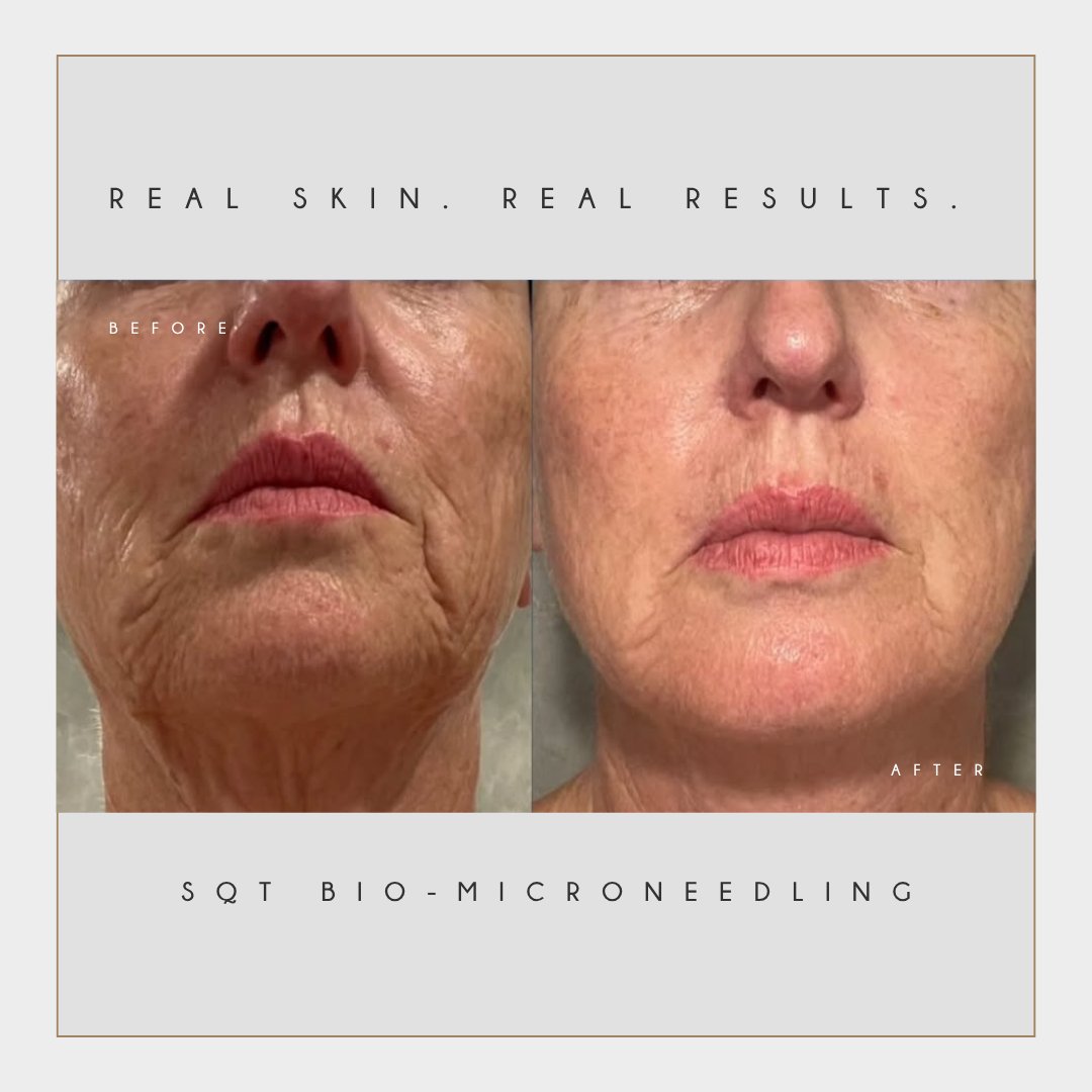 Transformation Tuesday ✨
This is your sign to stop covering your skin — and start correcting it.
Our SQT Skin Treatment works beneath the surface to:
✔️ Improve skin texture
✔️ Reduce acne & congestion
✔️ Minimize pores
✔️ Brighten dull, tired skin
No filters. No heavy makeup. Just real results.
Because glowing skin isn’t luck — it’s the right treatment.
Ready for your skin reset?
📩 DM us to book your consultation
📸 @sqt_australia
#TransformationTuesday #SQTResults #SkinTransformation #AcneTreatment #SkinRejuvenation #GlowingSkin #BrisbaneSkinClinic #RealResults #TBTBeauty