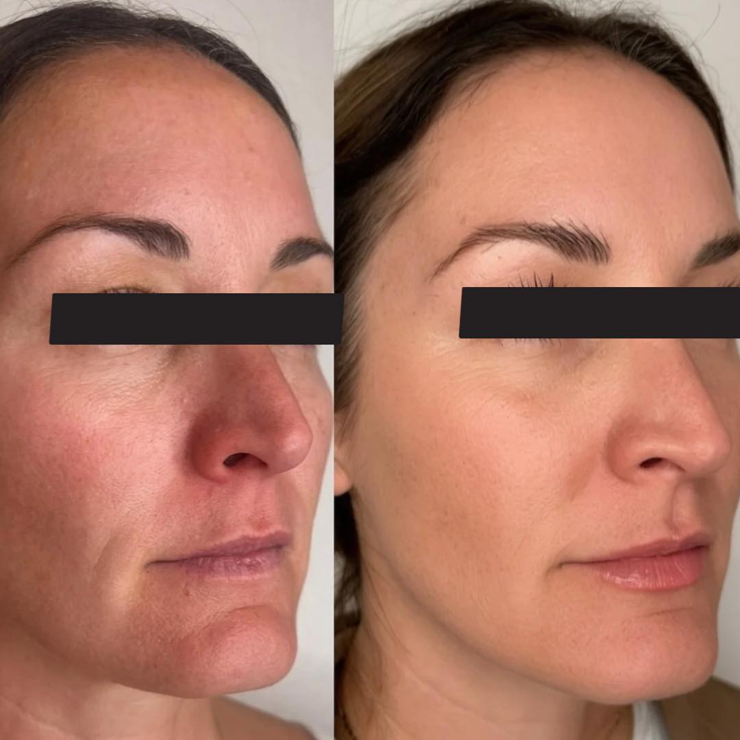 SKINVIVE™💧
the future of injectable skincare is here.
This isn’t filler. This is skin quality.
Skinvive works beneath the surface using microdroplets of hyaluronic acid to deeply hydrate, smooth, and refine your skin from within. Think improved texture, increased glow, and that lit-from-within look—without adding volume.
✨ smoother skin
✨ improved hydration
✨ natural, radiant glow
✨ no overfilled look
Real people. Real results. Real skin—just better.
If your goal is healthy, glass-like skin… this is it👏🏼