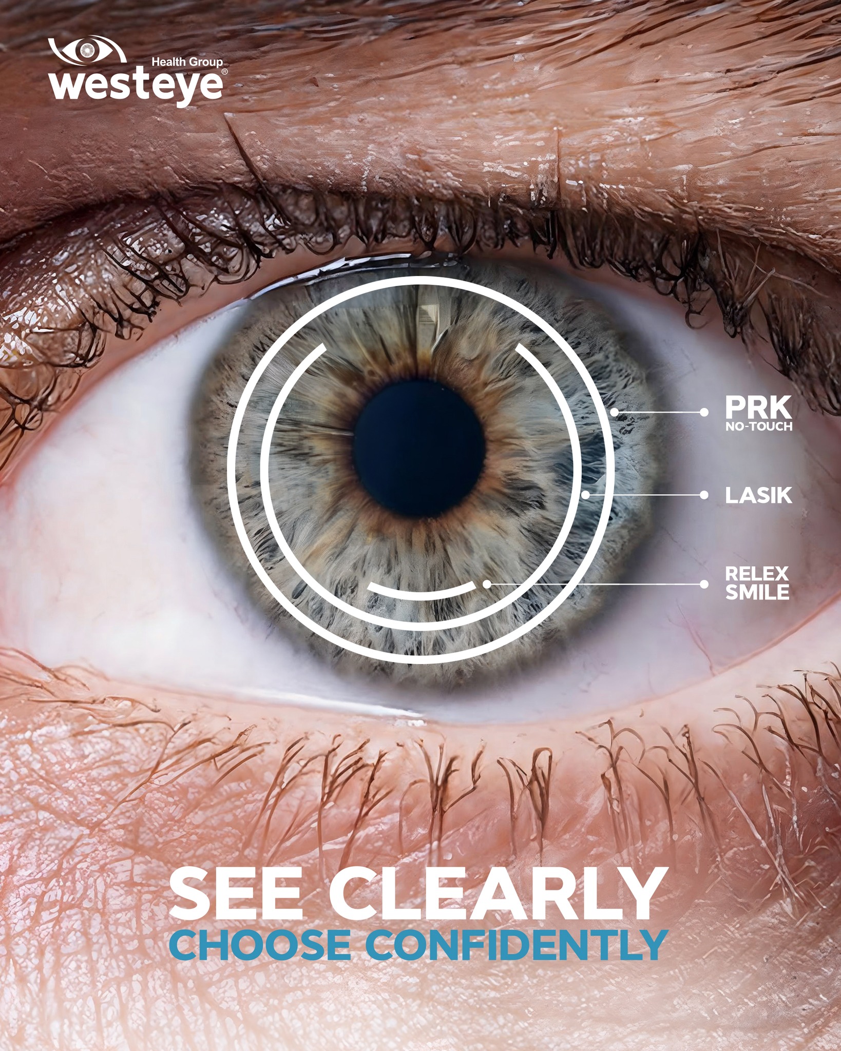 Same goal. Different science.
From surface treatment to flap to micro-incision, every method reshapes your vision in its own way.
We help you choose what your eyes truly need.
#westeyehospitals