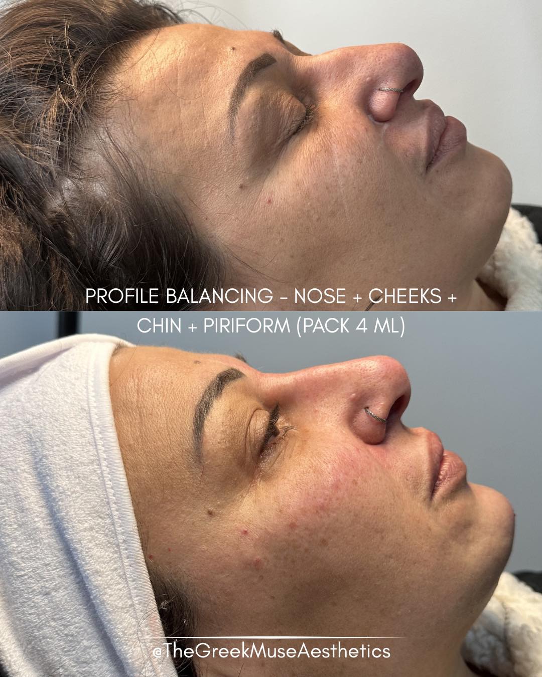 ✨ Malar Lift & Full Face Balancing ✨
A subtle lift can completely transform the face — without looking “done”.
In this case, we performed a malar lift by enhancing the cheekbones and the piriform fossa, combined with a non-surgical nose refinement.
💉 Total: 4 ml of hyaluronic acid
This approach is often referred to as “full face balancing”
💎 Why this technique?
• Restores mid-face volume
• Lifts and supports the lower face
• Softens nasolabial folds
• Improves facial proportions
• Enhances natural beauty without overfilling
📍 Areas treated:
• Cheekbones (malar region)
• Piriform fossa (for structural support)
• Nose (for profile harmonization)
✨ The result:
A more lifted, structured and harmonious face — while keeping a natural look.
📍 France • Greece
🔗 booking & réservation en bio
#malarlift #fullfacebalancing #facialharmonization #aestheticmedicine #dermalfillers #hyaluronicacid #cheekfiller #nosefiller #nonsurgicalrhinoplasty #facialbalance #naturalenhancement #beautywithoutfilters #aestheticinjector #medicalaesthetics #beforeandafter