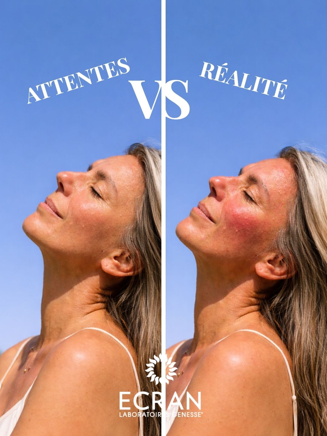 On imaginait déjà une peau bronzée et lumineuse après une journée au soleil… ✨
Et au final : un coup de soleil et une peau mise à rude épreuve.
Le soleil oui, mais sans oublier de protéger sa peau !
#protectionuv #spf #preventionsolaire #crèmesolaire #ECRAN #printemps #attentesVSréalité