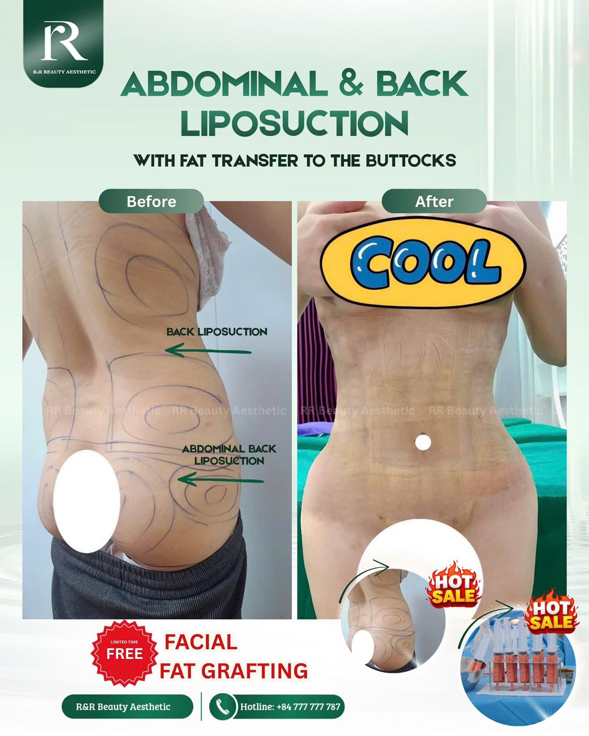 ✨ ABDOMINAL & BACK LIPOSUCTION + FAT TRANSFER
🎁 FREE facial fat grafting for a more youthful look
No matter how much you try…
your waist still looks wide and undefined.
💎 BEFORE/AFTER + BODY SHAPE
✔ Remove stubborn fat from abdomen & back instantly
✔ Eliminate back rolls and create a slimmer waistline
✔ Sculpt a more defined, feminine silhouette
✔ Transfer fat to enhance fuller, rounder curves
✔ Visible before & after transformation
⚡ Book your consultation now before slots fill up.
.
.
.
#rrbeauty #liposuction #bodycontouring #fattransfer #beforeafter
abdominal liposuction back liposuction waist slimming procedure fat transfer body contouring surgery stubborn fat removal clinic near me aesthetic body shaping before after