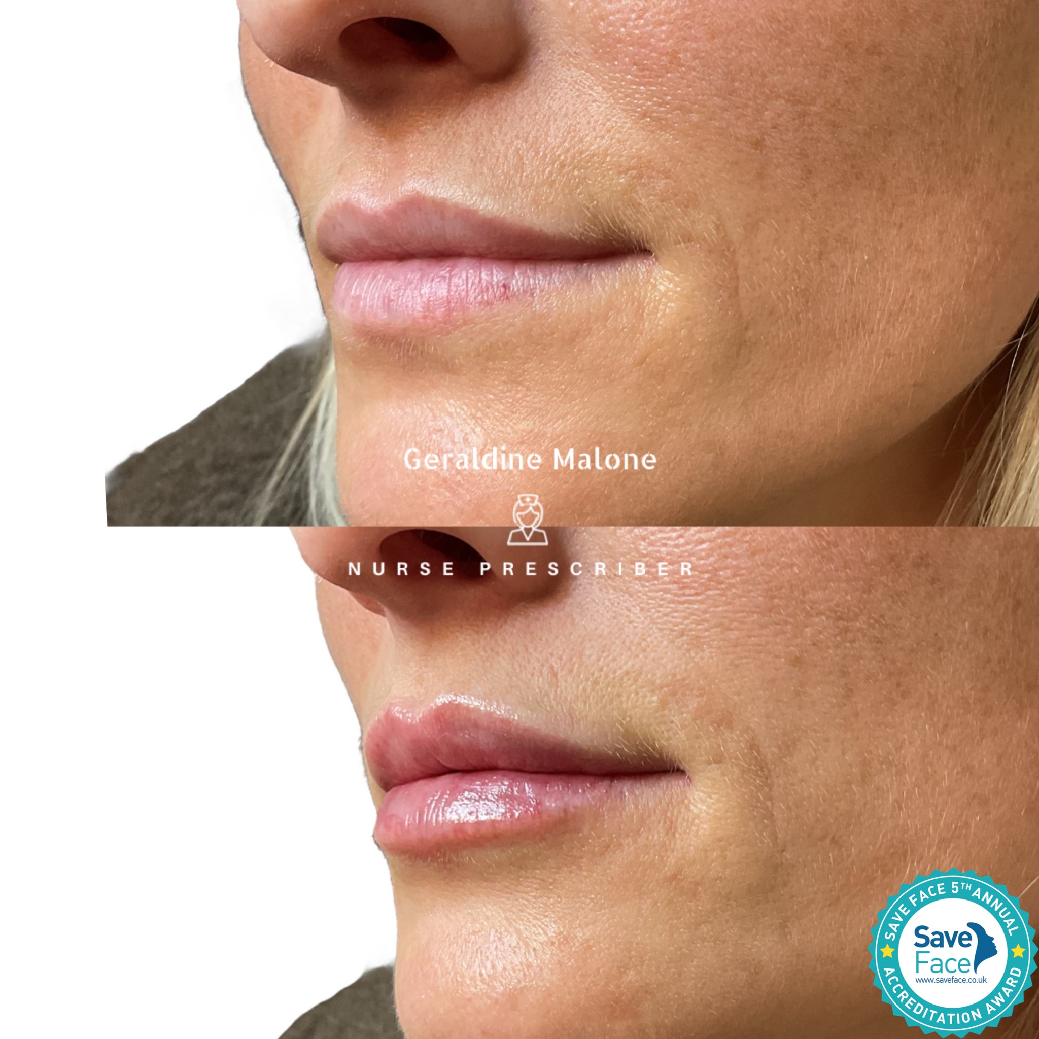 0.5ml Lip Enhancement
A subtle, natural enhancement — adding soft volume and hydration while preserving the client’s natural shape and balance.
💉 Treatment: 0.5ml
💷 Price: £145
⏱ Recovery: 24–48 hours
⏳ Results: 6–12 months
✔️ No edited images
✔️ Performed by Nurse Prescriber Geraldine Malone
✔️ Save Face Registered Clinic
📅 Book now:
https://www.geraldinemalone.co.uk/book-appointment
📞 024 7792 1812
📧 geraldinemaloneaesthetics@outlook.com