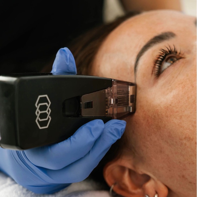 Meet Morpheus8 at View Laser.
This advanced treatment combines microneedling + radiofrequency (RF) energy to work below the surface, stimulating collagen, tightening skin, and improving overall texture - all in one treatment.
Why everyone is loving Morpheus8
- Targets fine lines, wrinkles + skin laxity
- Improves acne scars + texture
- Stimulates deep collagen + elastin production
- Tightens and contours for a smoother, firmer look
Because it penetrates deeper than traditional microneedling, Morpheus8 is ideal for next-level rejuvenation without surgery or major downtime.
📞 Call 604-943-9399
📧 reception@viewlaser.com