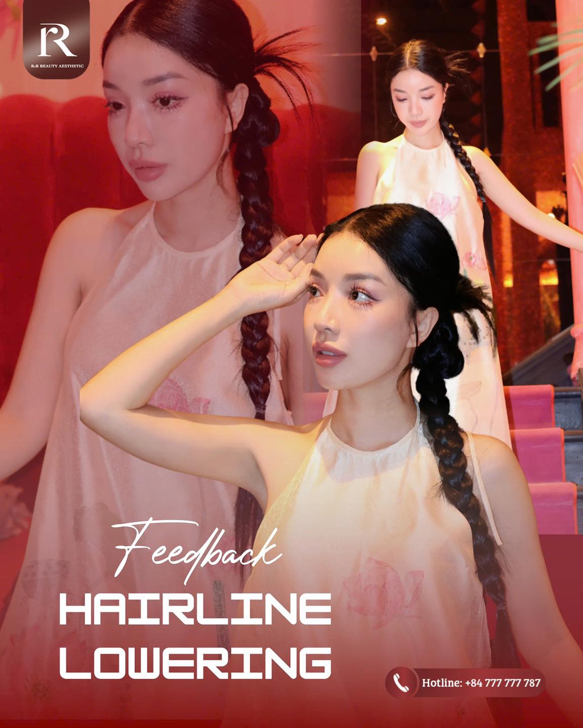 ✨ HAIRLINE LOWERING
✔ Lower the hairline to create a more balanced face shape
✔ Improve facial proportions for a softer, more harmonious look
✔ Natural-looking results that blend seamlessly
⚡ Message us now to book your consultation.
.
.
.
#rrbeauty #hairlinelowering #facialbalance #beforeafter #aestheticclinic
hairline lowering procedure forehead reduction surgery reduce forehead size aesthetic clinic near me facial proportion correction natural hairline surgery