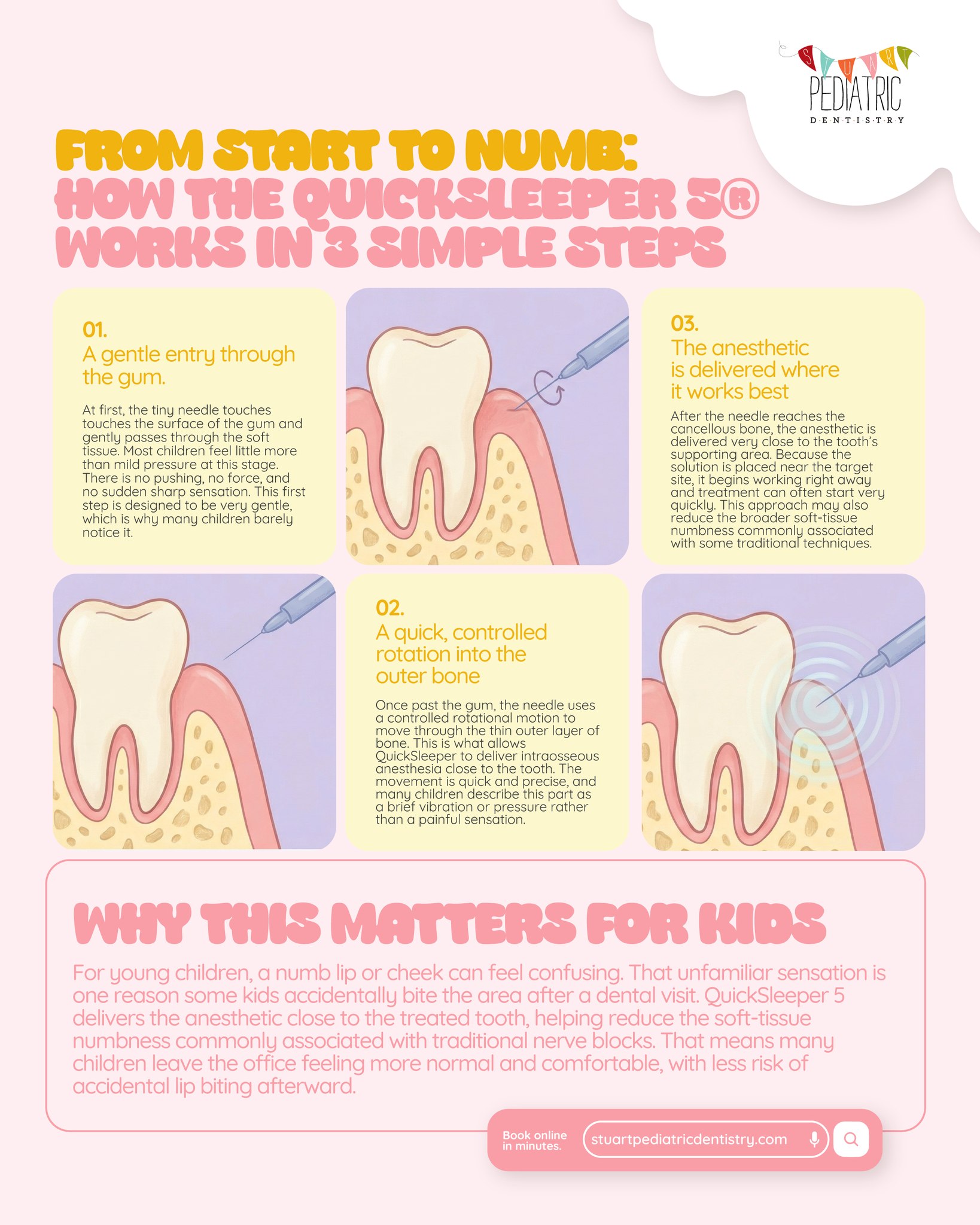 From start to numb: here’s why QuickSleeper® can be such a helpful option for kids in selected cases.
Instead of creating that big “fat lip” feeling some children dislike after traditional numbing, QuickSleeper® is designed to place the anesthetic close to the treated tooth with a precise, controlled flow. For many kids, that can mean an easier experience in the chair and a more comfortable recovery afterward.
And for parents, that matters too, because less soft-tissue numbness can mean less accidental lip or cheek biting after the visit.
We put together a simple visual to show how it works in 3 steps, and we also wrote a blog that explains the technology in a parent-friendly way.
Read the full blog at the link in bio to learn how QuickSleeper® may help make dental treatment feel easier for kids and less stressful for families.
#StuartPediatricDentistry #PediatricDentist #KidsDentist #QuickSleeper #DentalAnesthesia