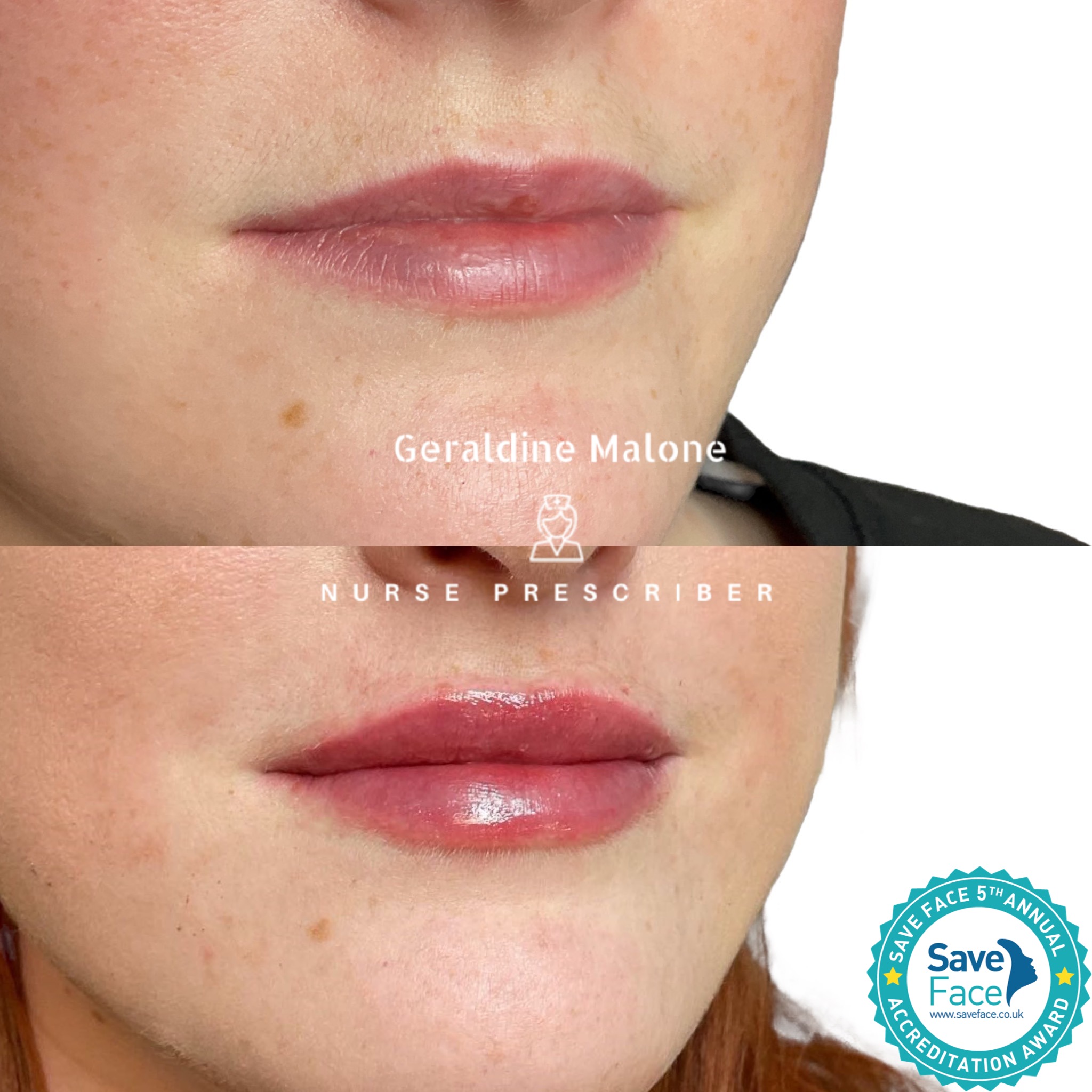 0.5ml Lip Enhancement 👄
Enhance your natural beauty with subtle hydration and refined volume — tailored to maintain your unique shape and proportions.
💉 Pricing
0.5ml — £145
1ml — £225
⏱ Recovery: 24–48 hours
⏳ Results: 6–12 months
✔️ No edited images
✔️ Performed by Nurse Prescriber Geraldine Malone
✔️ Save Face Registered Clinic
📅 Book now:
https://www.geraldinemalone.co.uk/book-appointment
📞 024 7792 1812
📧 geraldinemaloneaesthetics@outlook.com