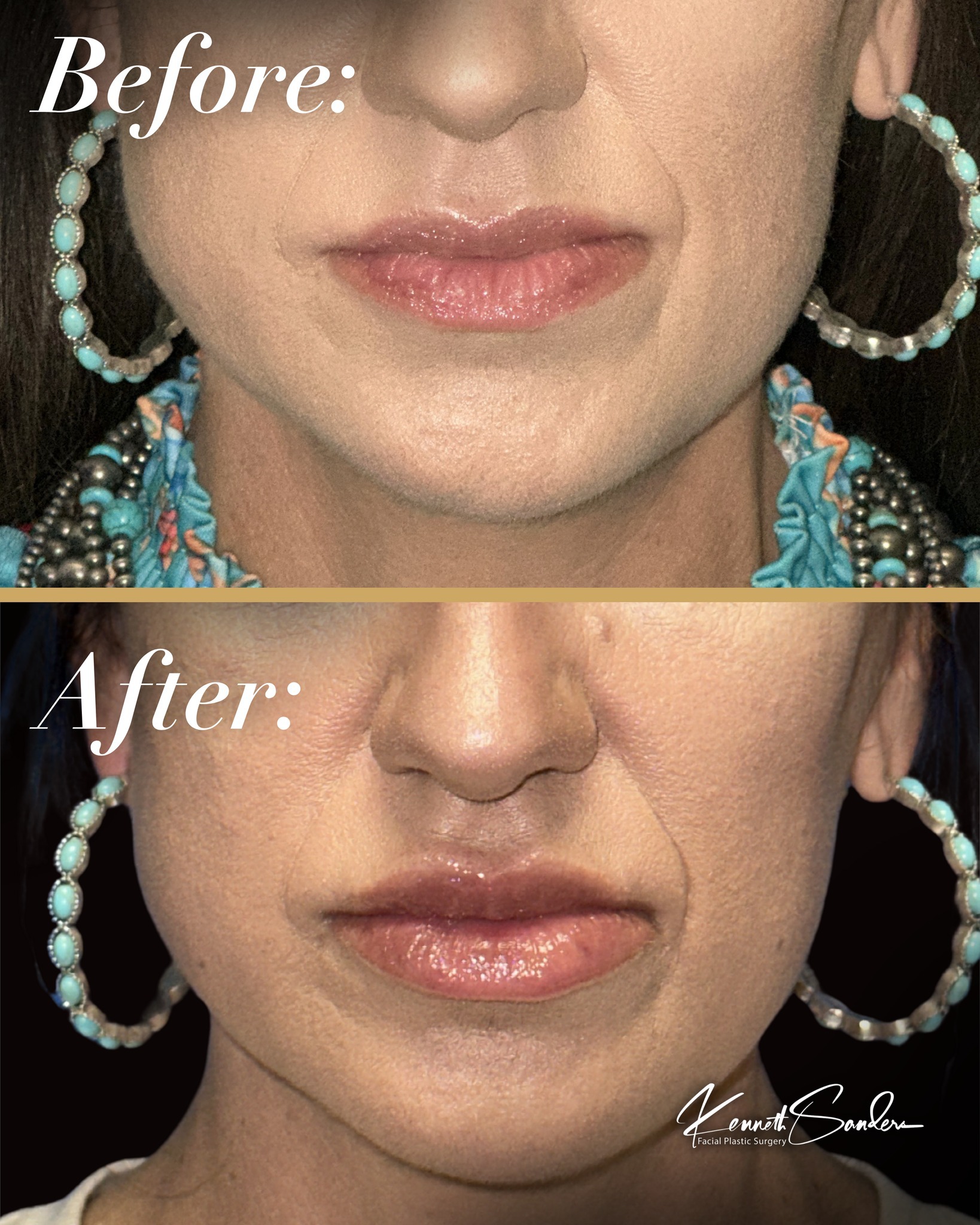 Fresh from our Filler Event đ
Lip filler is about so much more than volume. Itâs about shape, balance, and technique.
Dr. Sanders has been using the cannula technique for over a decade, allowing filler to be placed with less trauma to the tissue. What that means for you is typically less bruising, less swelling, and a smoother, more comfortable experience.
It also allows for more precise placement, which is how we get results that look soft, natural, and never overdone.
Missed the event? Donât worry, weâve got you. Beautiful lips arenât limited to one weekend.
Call (318) 698-8711 to book your appointment.
#LipFillerShreveport #CannulaTechnique #JuvedermShreveport #DrKennethSanders #ShreveportMedspa