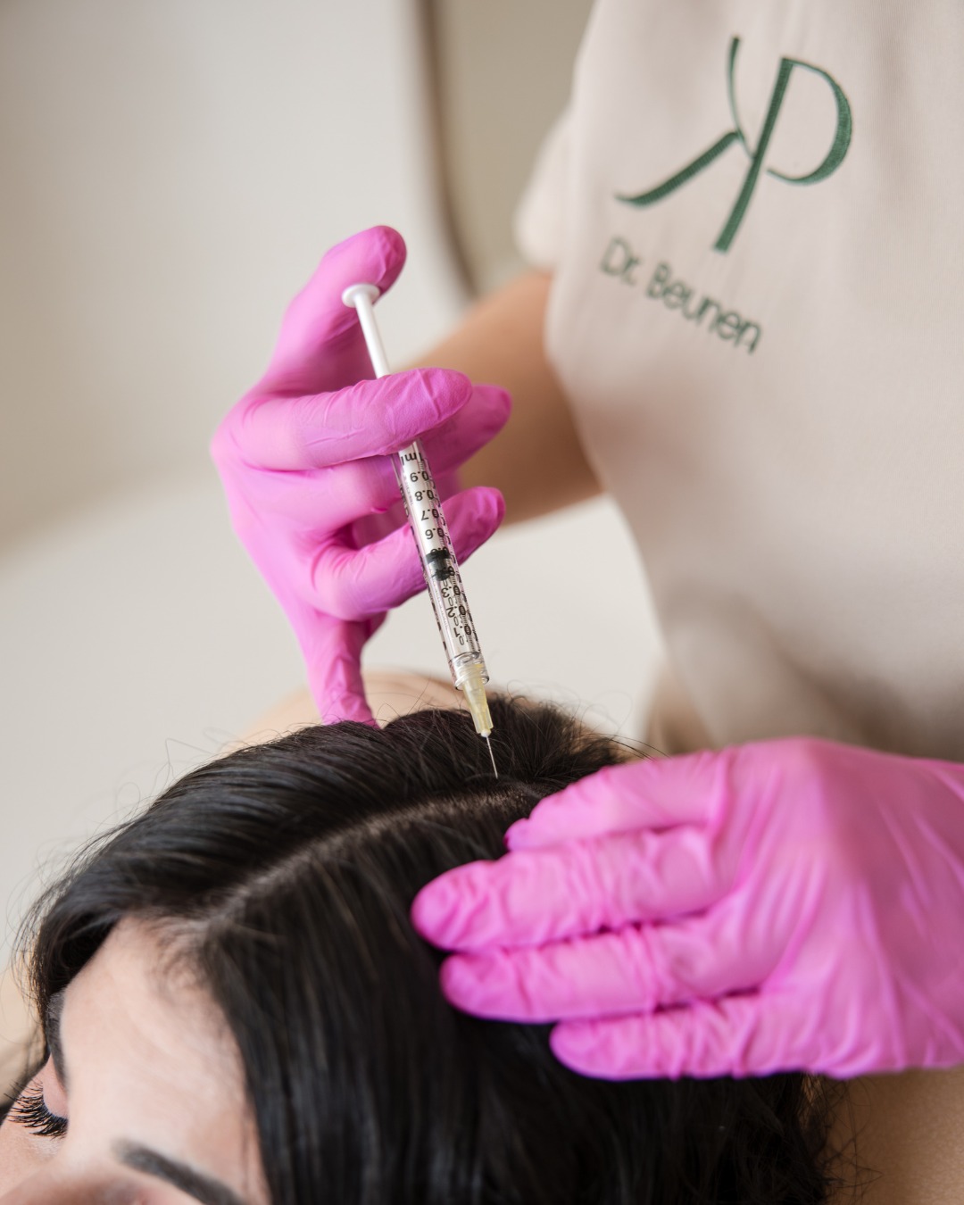 Bij haarverlies denken veel mensen eerst aan shampoos of supplementen. Wist je dat ook het eigen bloed een rol kan spelen in een behandeling?
Bij een PRP-behandeling (Platelet-Rich Plasma) wordt een kleine hoeveelheid bloed afgenomen. Het plasma, dat rijk is aan groeifactoren, wordt vervolgens opnieuw geïnjecteerd in de hoofdhuid. Zo kunnen haarfollikels gestimuleerd worden van binnenuit.
Deze behandeling wordt vaak toegepast bij haarverlies of dunner wordend haar en maakt gebruik van lichaamseigen materiaal.
⚠️ Aan elke behandeling zijn risico’s verbonden. Bespreek daarom steeds samen met je arts of deze behandeling voor jou geschikt is.
#PlastischeChirurgie #SurgicArt #PUURkliniek #haarverlies #hoofdhuid #PRP