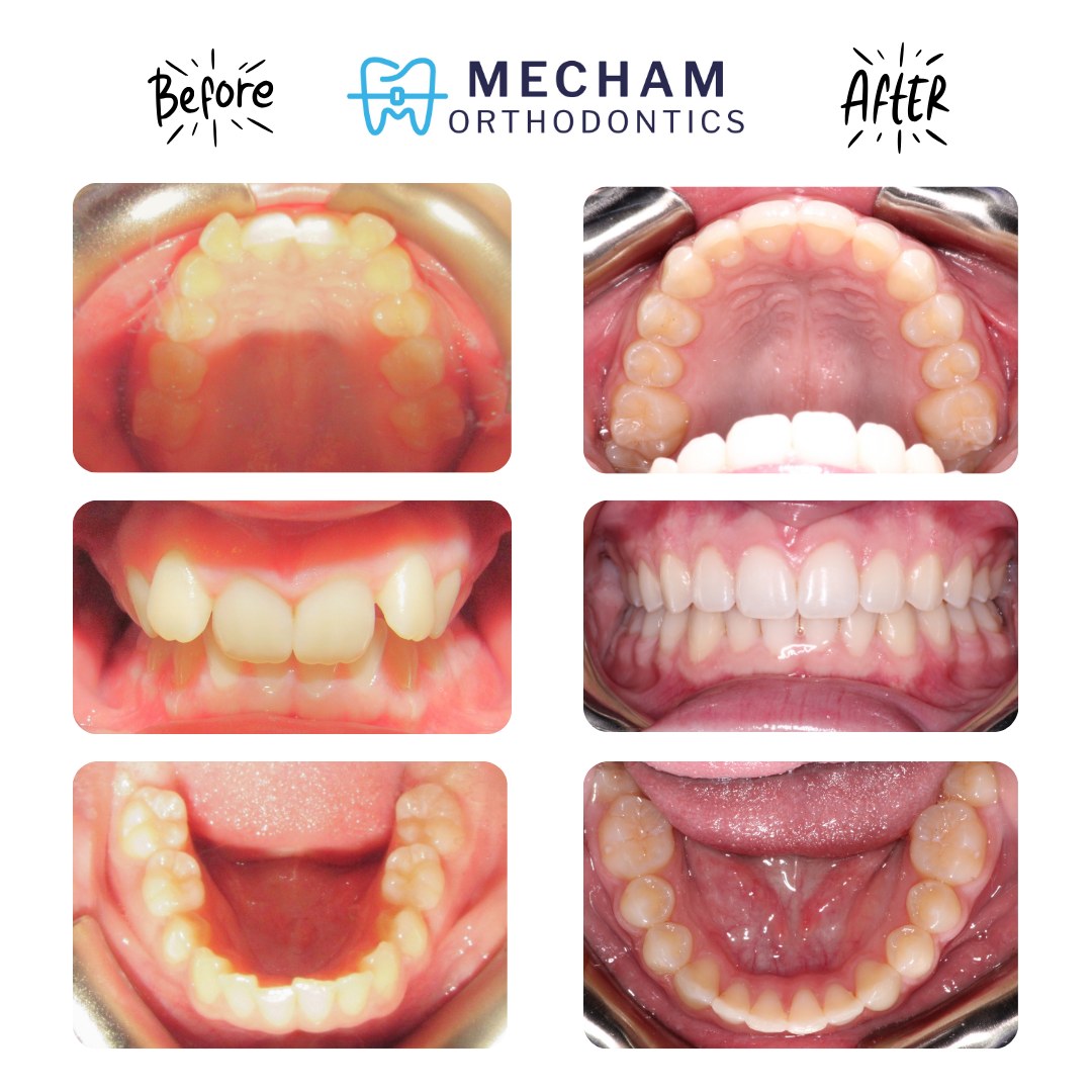Big smiles over here π
From a deep overbite to a beautifully balanced smile β¨
We corrected her extra overbite using an @americanortho PowerBar bite corrector and rubber bands, then finished her case with gentle enamel contouring to dial in every detail. The result, confident, natural, and absolutely stunning.
We are so excited for her and this new smile she gets to show off every day π¦·π
#MechamOrtho #MechamOrthodontics #Braces #TeenBraces #BeforeAndAfter #SmileTransformation #Orthodontics #SmileGoals