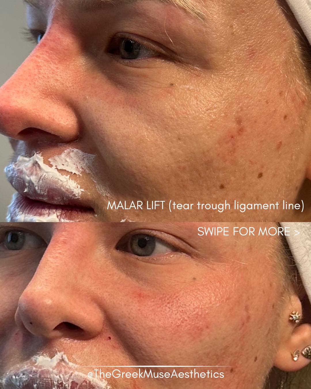 Malar support to reduce shadow lines under the eyes ✨
• Supporting mid-face structure
• Reducing the tear trough shadow
• Restoring a fresher look
💉 Not filling the line — lifting the structure.
📍 France • Greece
🔗 booking & réservation en bio
#malarlift #teartrough #undereye #aestheticmedicine #facialrejuvenation