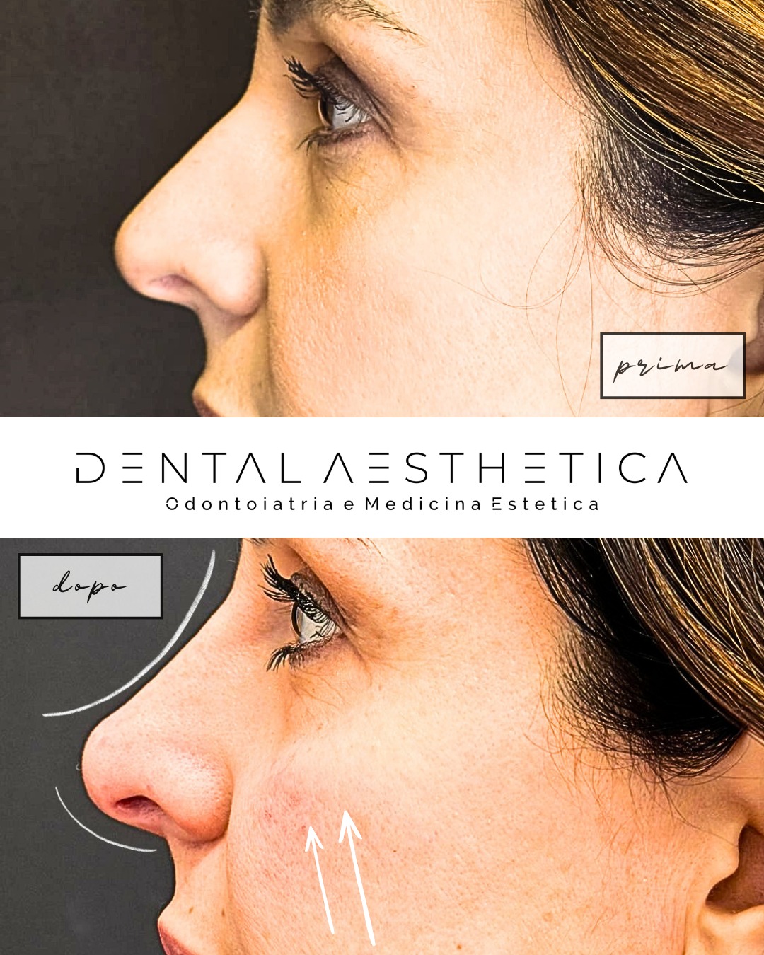 Rinofiller
Filler zigomi
Filler nasolabiali
👩⚕️Dott.ssa Silvia Ciarrocchi
Dental Aesthetica
✨ Odontoiatria e Medicina Estetica
📍 viale della Grande Muraglia 256 - zona EUR Torrino
📱 375 88 47 069
#medicinaestetica #roma #rinofiller #filler