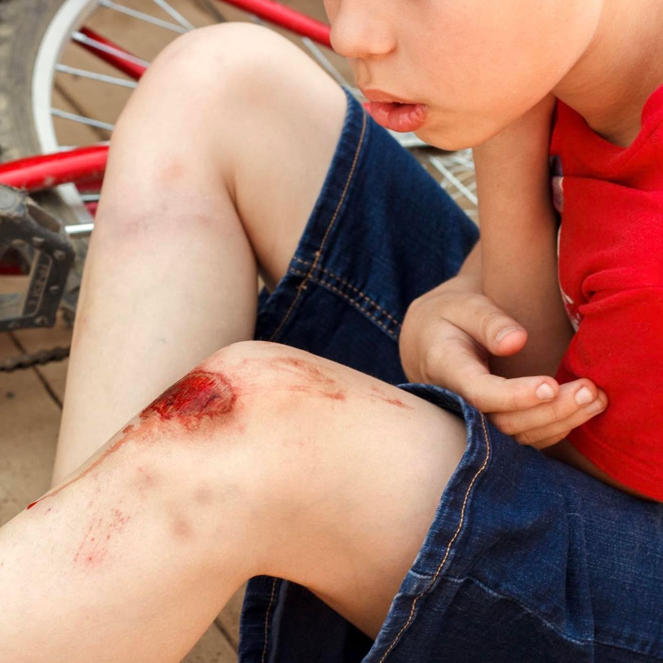 Cuts and grazes happen every day. Knowing what to do straight away can make all the difference to healing and comfort.
If it’s a minor wound:
Start by rinsing it under clean, running water. This helps wash away dirt and reduces the risk of infection.
Gently dry around the edges of the wound. Try not to disturb the area itself.
If needed, cover it with a clean plaster or dressing. Always check first that the person is not allergic to adhesives.
Avoid the temptation to use lotions, potions, creams, or antiseptics. For simple wounds, clean water is usually all that’s needed.
Keep it simple. Keep it clean. Let the body do the rest (it does know what it is doing).
If you’d like to feel more confident dealing with everyday situations like this, our courses are designed to give you practical, real world skills you can actually use.
www.training.dtmk.co.uk
01908 112111
enquiries@dtmk.co.uk
#BystandersToLifesavers #NobodyLeftWithoutCare #PreparedPeople #SaferWorkplaces #StrongerFamilies #DTMK #FirstAid #FirstAidTraining #MiltonKeynes #Buckinghamshire #Bedfordshire #Northamptonshire #Oxfordshire